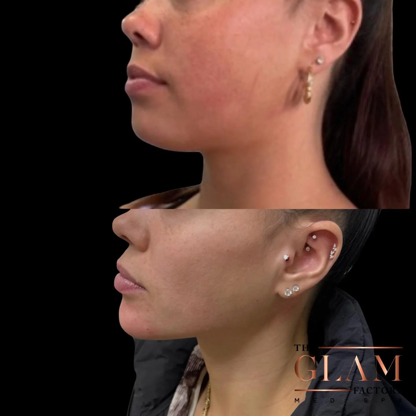 Angles so clean they deserve their own spotlight. 📐🌟

#igotitfrombotoxxbarbi #botoxxbarbi👩🏼&zwj;⚕️ #briantreema #bostonma #bostonmedspa