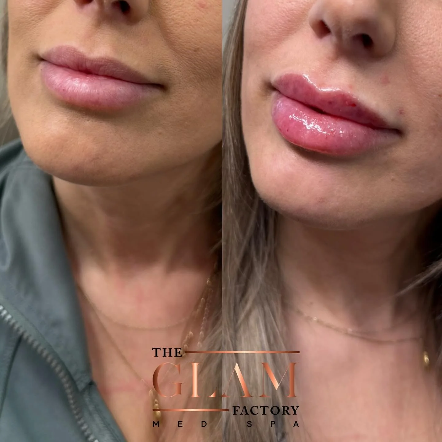 Just enough to enhance, never enough to distract 💋✨

The goal isn&rsquo;t bigger -it&rsquo;s balanced, soft, and effortless. Perfect lips should whisper, not shout.

#igotitfrombotoxxbarbi #botoxxbarbi👩🏼&zwj;⚕️ #botoxxbarbi #bostonmedspa #medspabo
