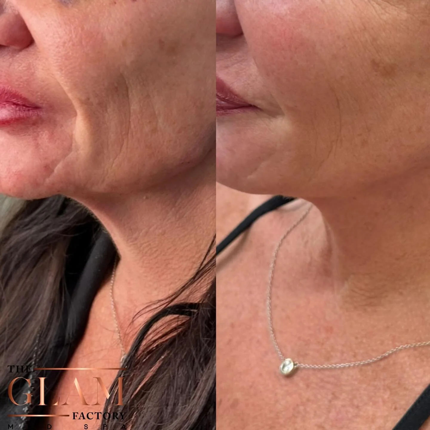 The power of Sculptra 👏🏻

➡️ Sculptra works differently than traditional filler. Instead of adding immediate volume, it stimulates your body&rsquo;s natural collagen production over time. This helps gradually improve skin thickness, elasticity, and