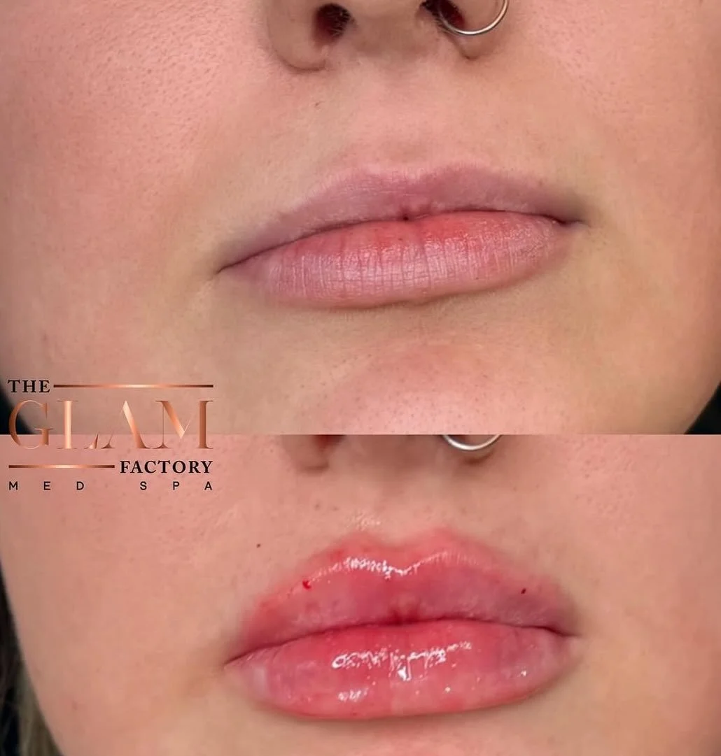 Pretty, pink, and ready for Spring 🌷

Want a plump pout to pair with your cute warm weather outfits? Book your appt today! 👄

#igotitfrombotoxxbarbi #botoxxbarbi👩🏼&zwj;⚕️ #bostonmedspa #medspaboston #bostoninjector