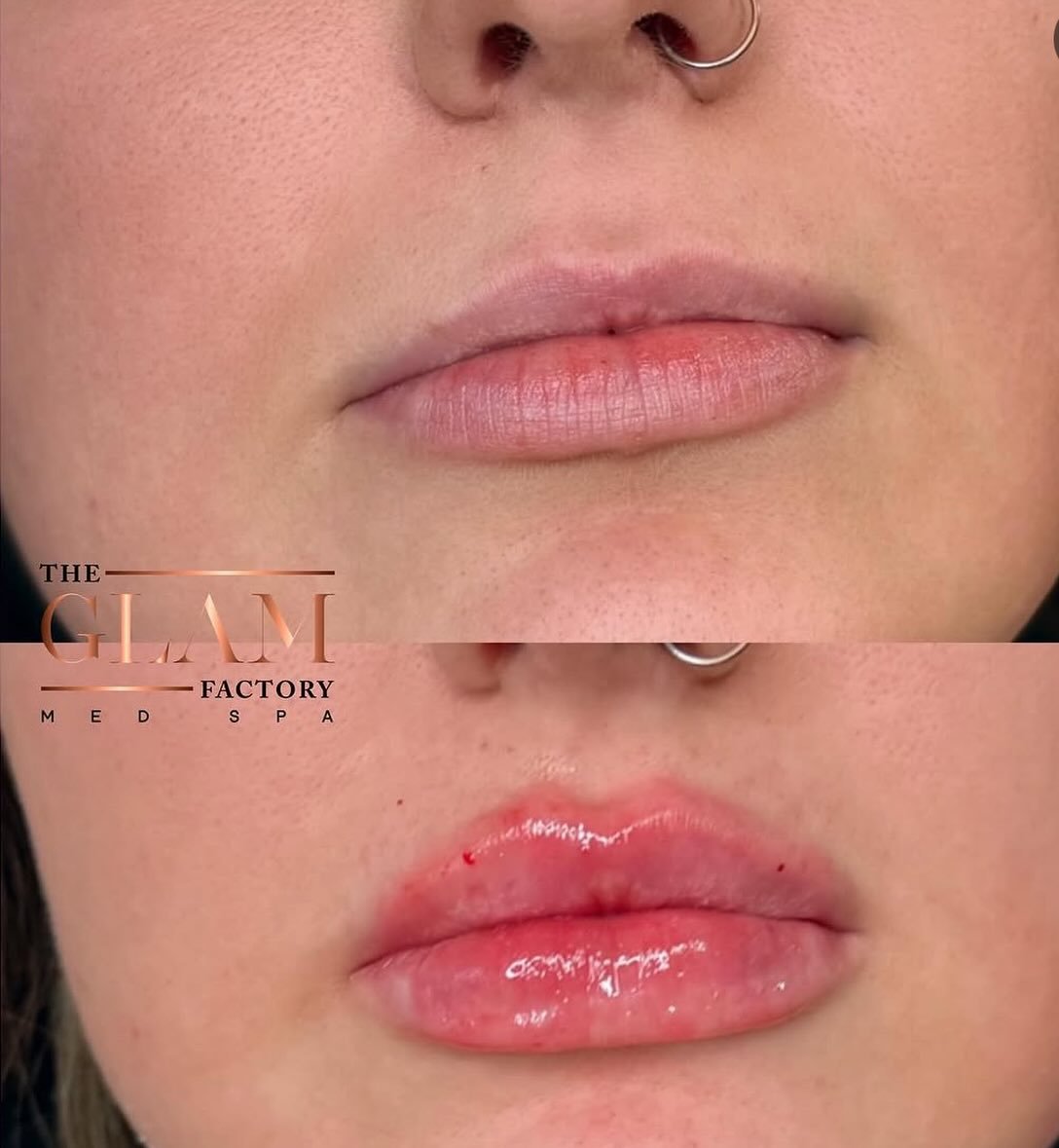 Imagine waking up to these lippies every day? 😍👄

Book your filler appt asap and let&rsquo;s get your hot girl summer ready to go!

#botoxxbarbi👩🏼&zwj;⚕️ #bostonmedspa #bostoninjector #medspaboston #braintreema