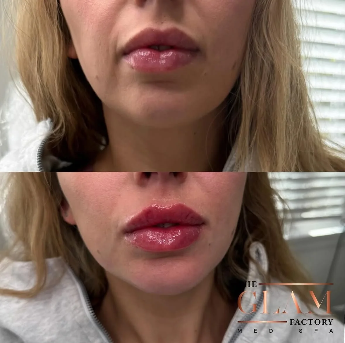 That lip &amp; chin filler combo though 👌🏻💉💋

#fillerresults #bostonmedspa #medspaboston #braintreema #igotitfrombotoxxbarbi