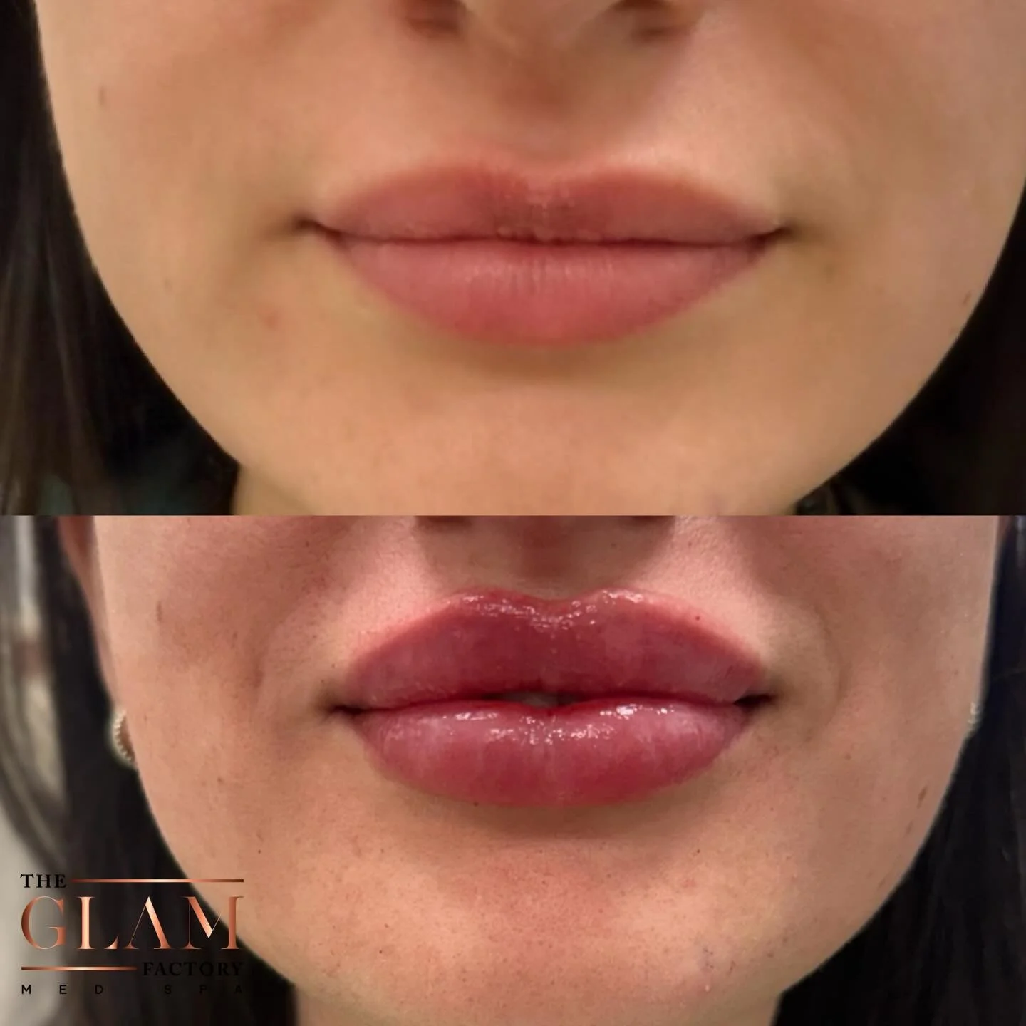 Fresh lips, fresh confidence 💋✨ It&rsquo;s glow up season after all! 💉👌🏻

#igotitfrombotoxxbarbi #botoxxbarbi👩🏼&zwj;⚕️ #botoxxbarbi #lipfillerboston #bostonmedspa
