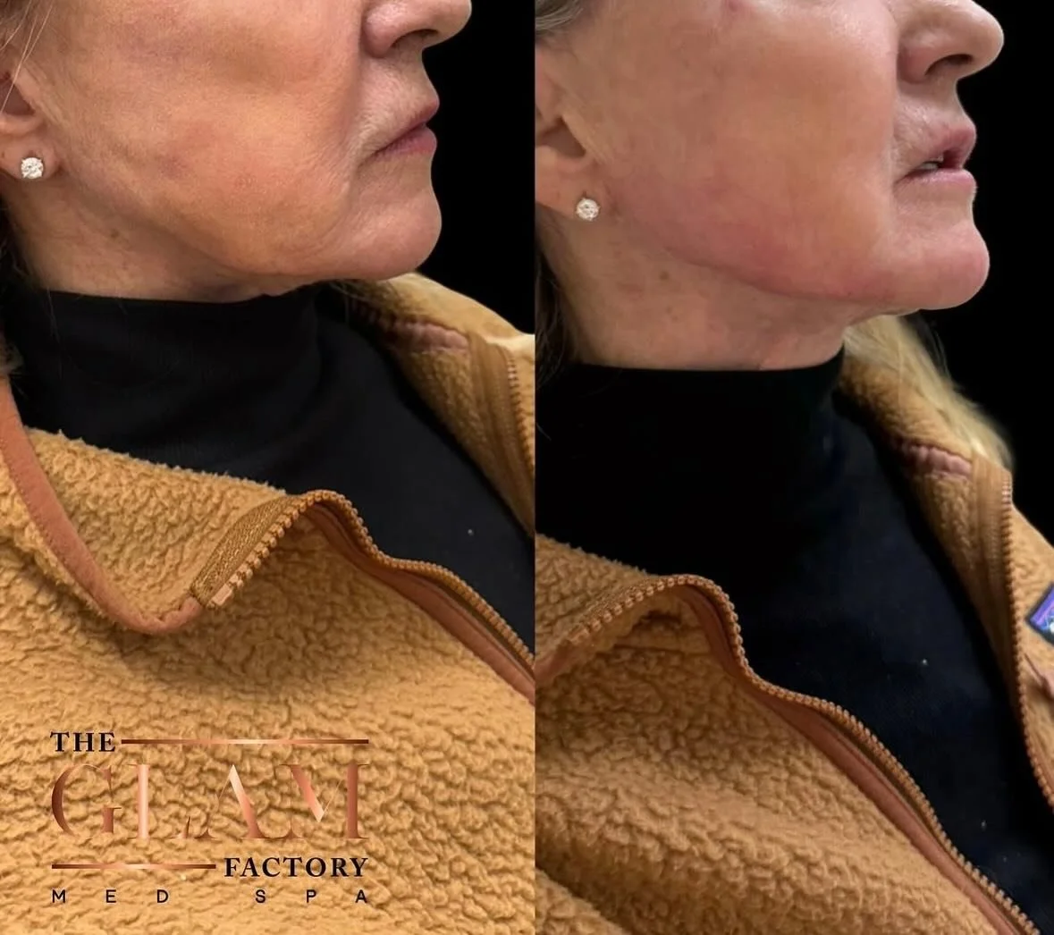 This transformation included jawline filler, nasolabial fold filler, and marionette line filler to restore balance, soften lines, and create a smoother, more defined profile, all while still looking completely natural. 💉

Ready for your refresh?

#i