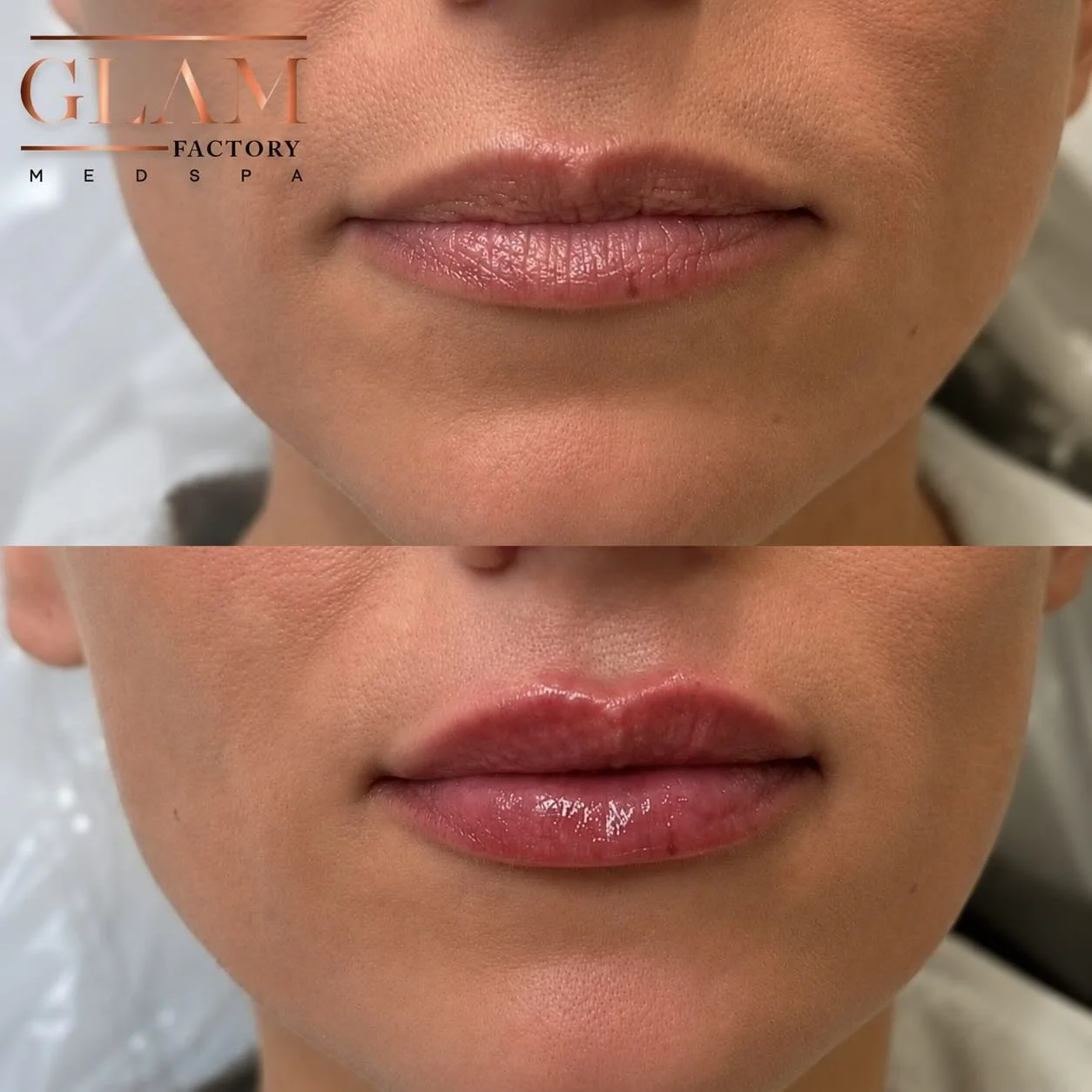 Fresh virgin lips immediately post injection 💋 0.5 mL (half syringe) for the perfect subtle enhancement &mdash; soft volume, hydrated finish, and natural definition.

#igotitfrombotoxxbarbi #botoxxbarbi👩🏼&zwj;⚕️ #botoxxbarbi #bostonmedspa #braintr