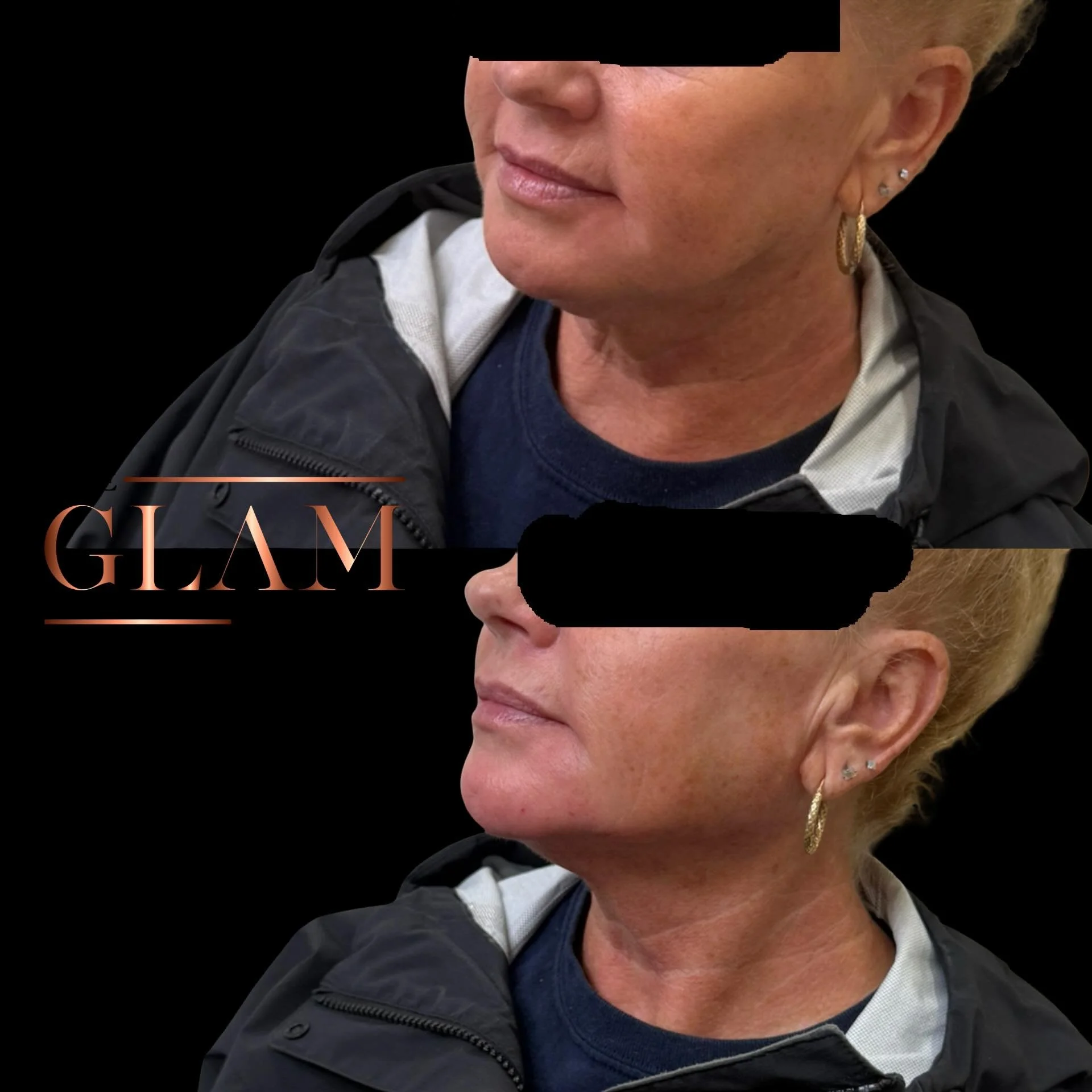 This before &amp; after highlights a subtle enhancement with improved definition through the jawline and chin while maintaining a soft, natural appearance.

Thoughtful aesthetic treatments are designed to refresh, bring confidence and never overpower