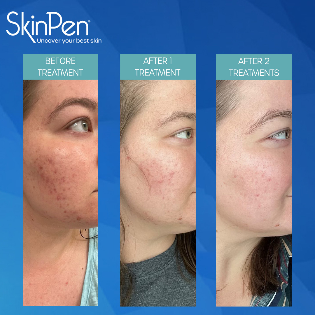 SkinPen Before and After the Glam Factory
