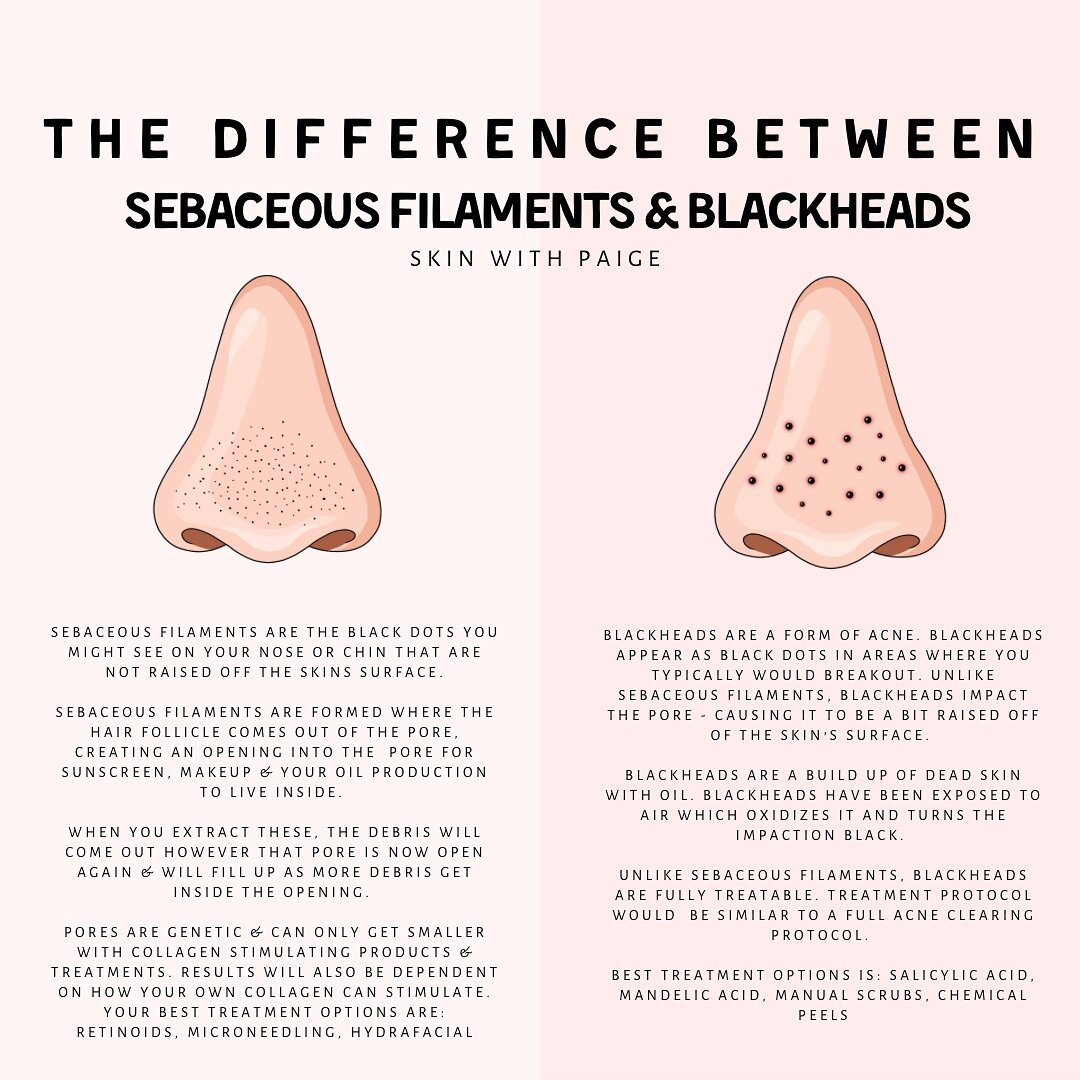 The difference between sebaceous filaments &amp; blackheads 👀

I have clients ALL the time come in &amp; think their blackheads are &ldquo;so bad&rdquo;, when in reality it&rsquo;s actually sebaceous filaments.  So let&rsquo;s break it down&hellip;
