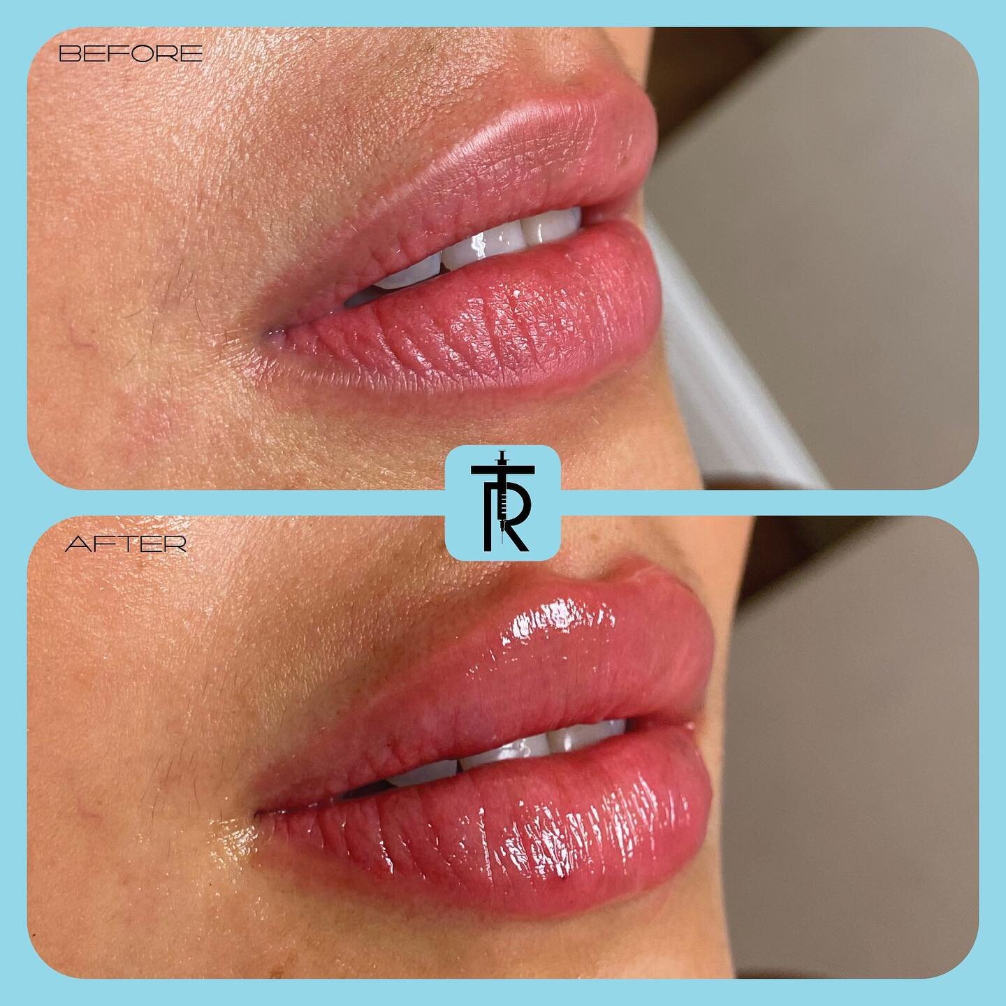 This patient desired full bodied lips with a defined Cupid&rsquo;s bow and border. This was achieved in 1 visit with 1 syringe of hyaluronic acid filler💉👄

📞 Call 212-249-8172 to book an appointment
Or click the link in bio to book online 💉
.
.
.