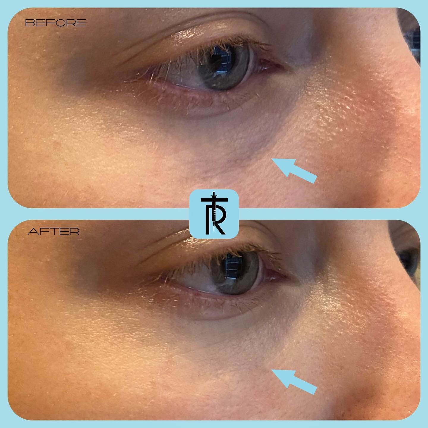 This patient had under eye hollowness and &ldquo;dark circles&rdquo; caused by volume loss which she stated she always had, but has gotten progressively worse over time. Hyaluronic acid filler was used to fill the hollows to create a smooth appearing