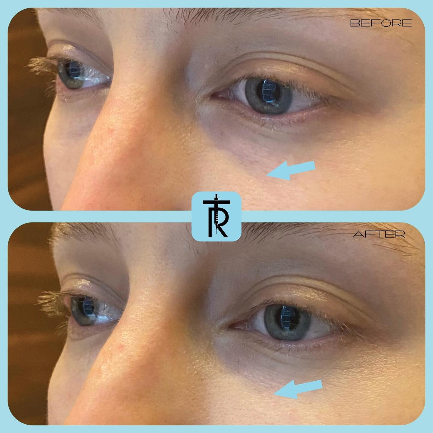 This patient had under eye hollowness and &ldquo;dark circles&rdquo; caused by volume loss which she stated she always had, but has gotten progressively worse over time. Hyaluronic acid filler was used to fill the hollows to create a smooth appearing