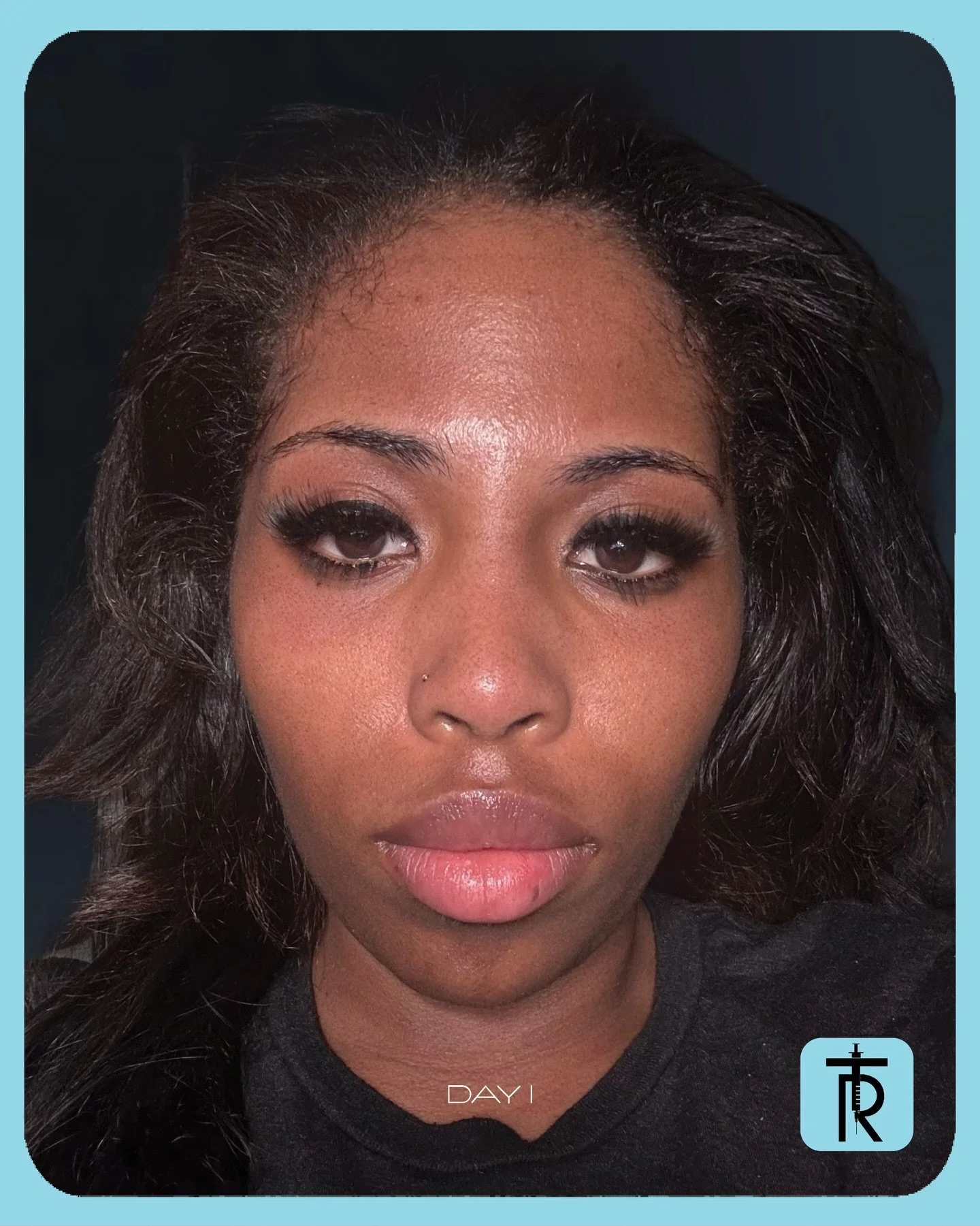 Moxi isn&rsquo;t just a treatment &mdash; it&rsquo;s a transformation.
Swipe through @najelym_ skin journey as she moves from day one redness to radiant, refreshed, glowing skin. ✨

With every photo, you&rsquo;ll see Moxi&rsquo;s magic unfold: smooth