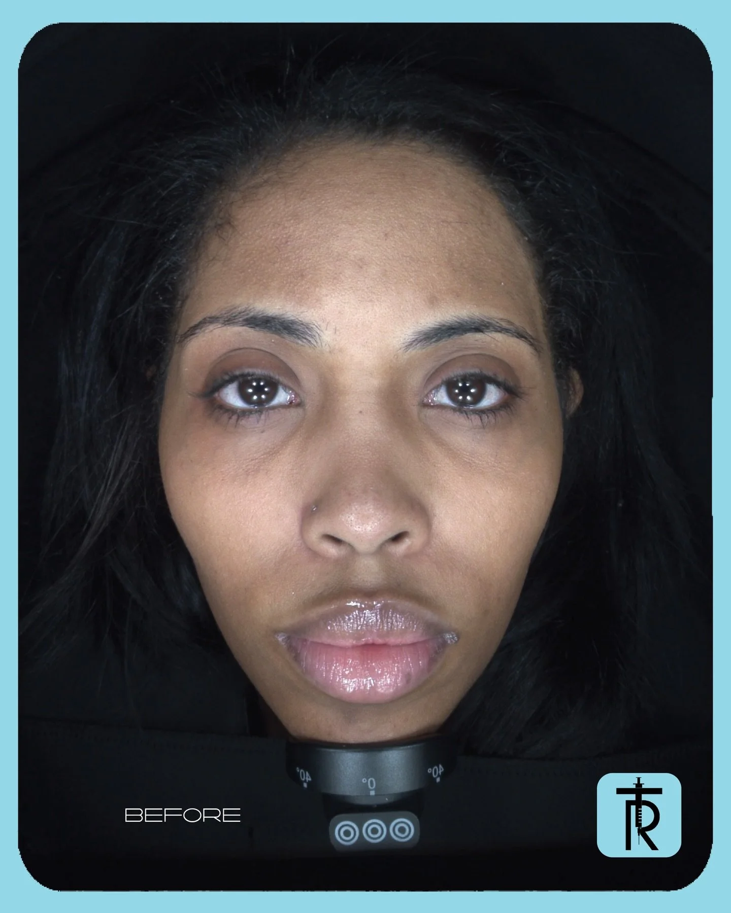 Before &rarr; After, guided by Alma IQ&reg; skin analysis.

By understanding what&rsquo;s happening beneath the surface, MOXI can be precisely tailored to target early sun damage, texture, and tone &mdash; with smart, cumulative results.

Swipe to se