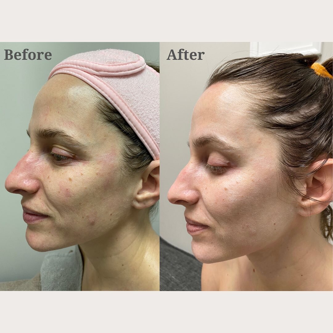 After only one session of EMS Mesotherapy Treatment, our client experienced a significant reduction in her fine lines and an improvement in skin texture - overall achieving a more radiant and rejuvenated appearance.

Visit our website to learn more a