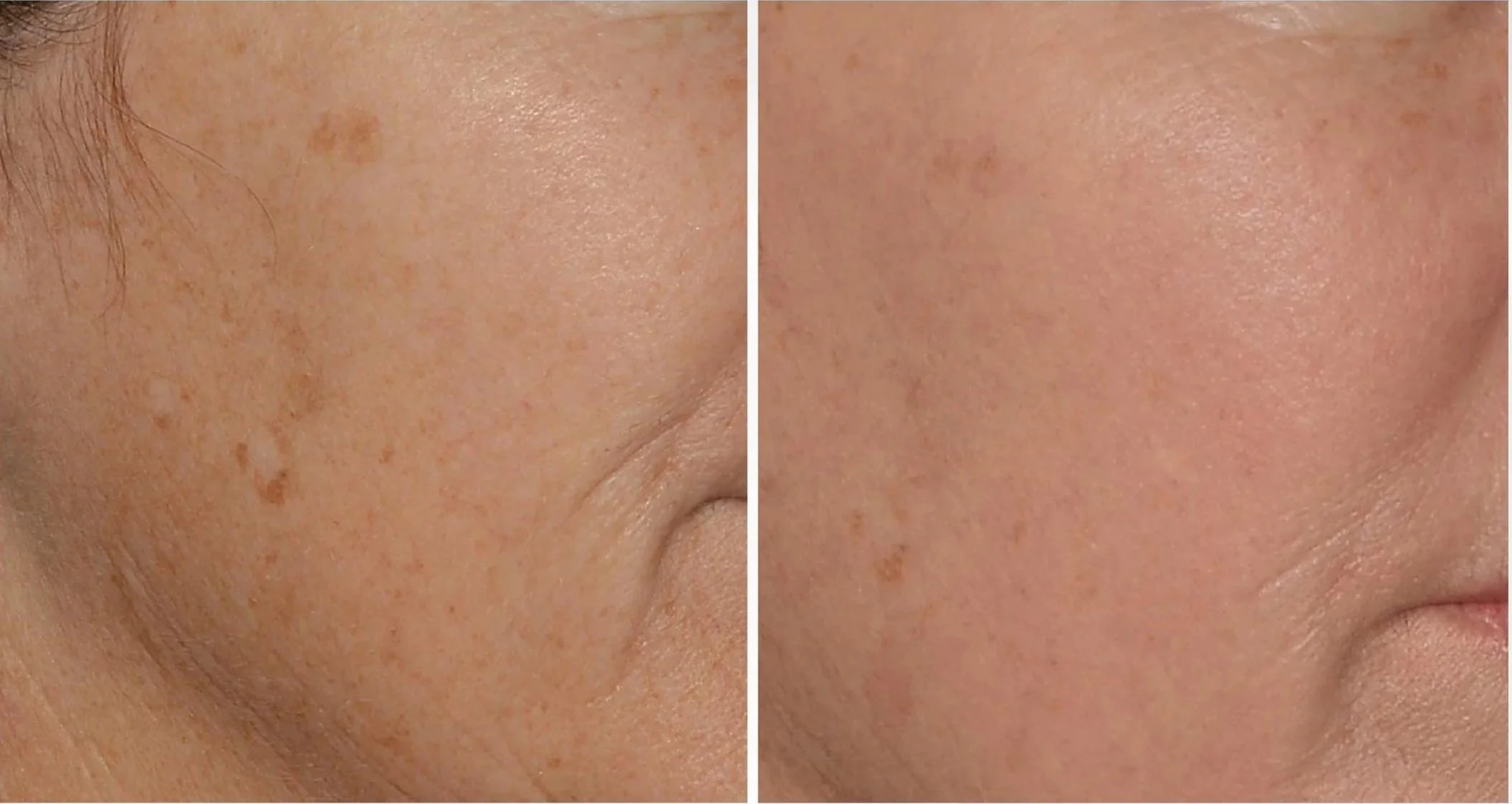 before and after face model with brown spots after shows less pigment and even tone