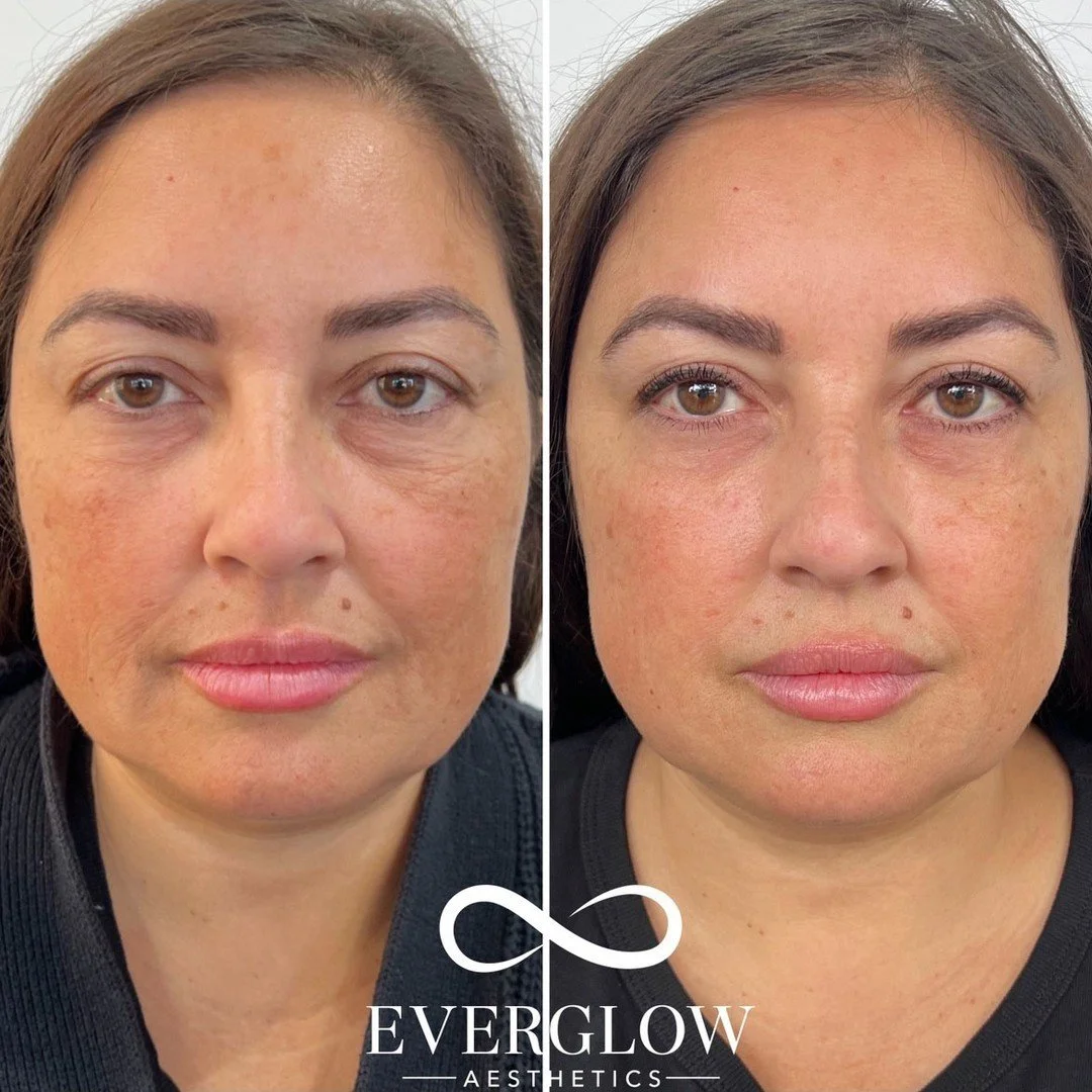 Side-by-side close-up images of a woman's face showing before and after skincare treatment, with the after photo displaying clearer skin, reduced wrinkles, and improved complexion, branded with Everglow Aesthetics logo.