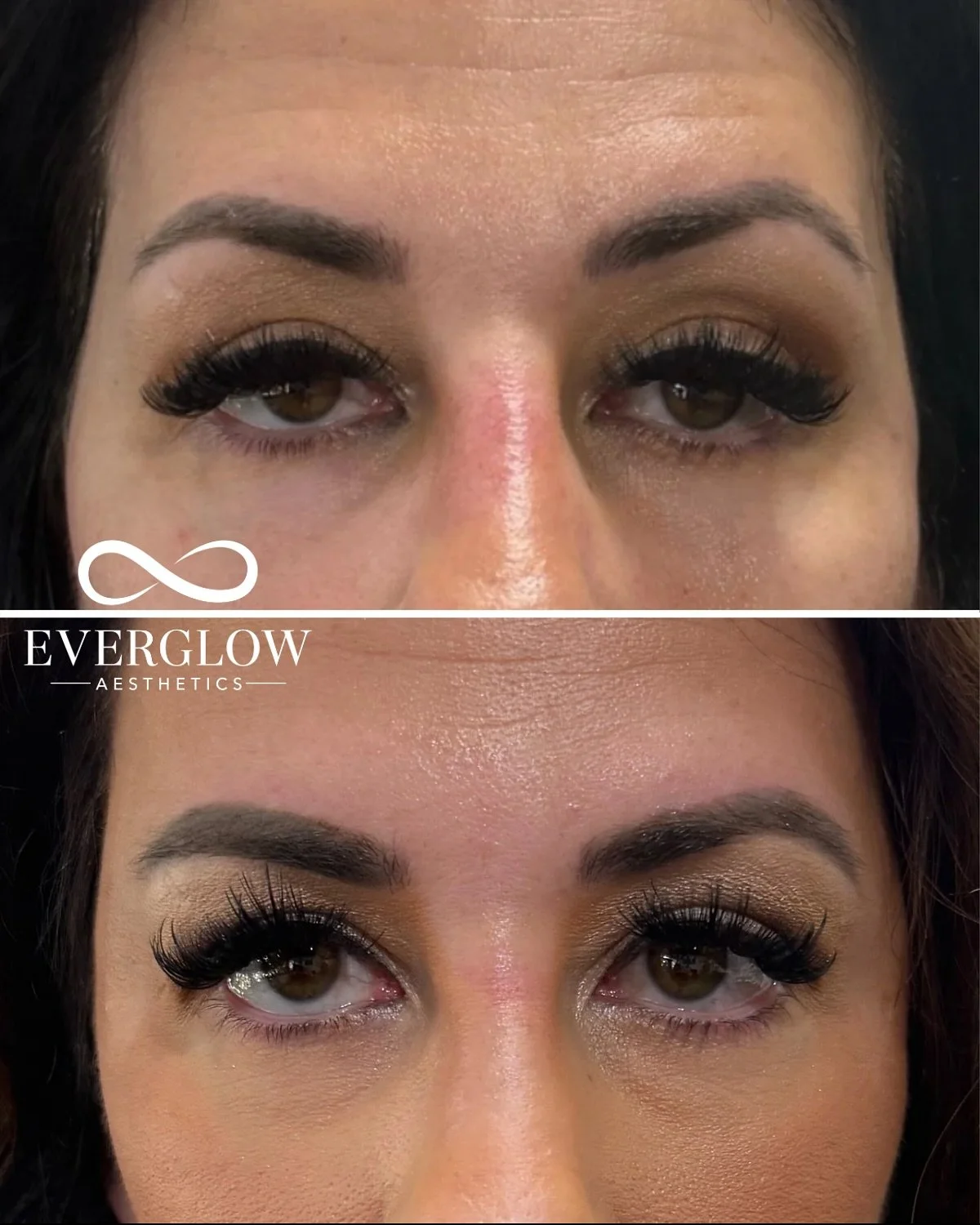 An underrated secret to looking refreshed? Temple filler 🙌
As we age, volume loss in this area can make the face appear hollow or tired. By injecting filler in the temples, it can restore balance to creating a smoother, more youthful look!
Drop yo