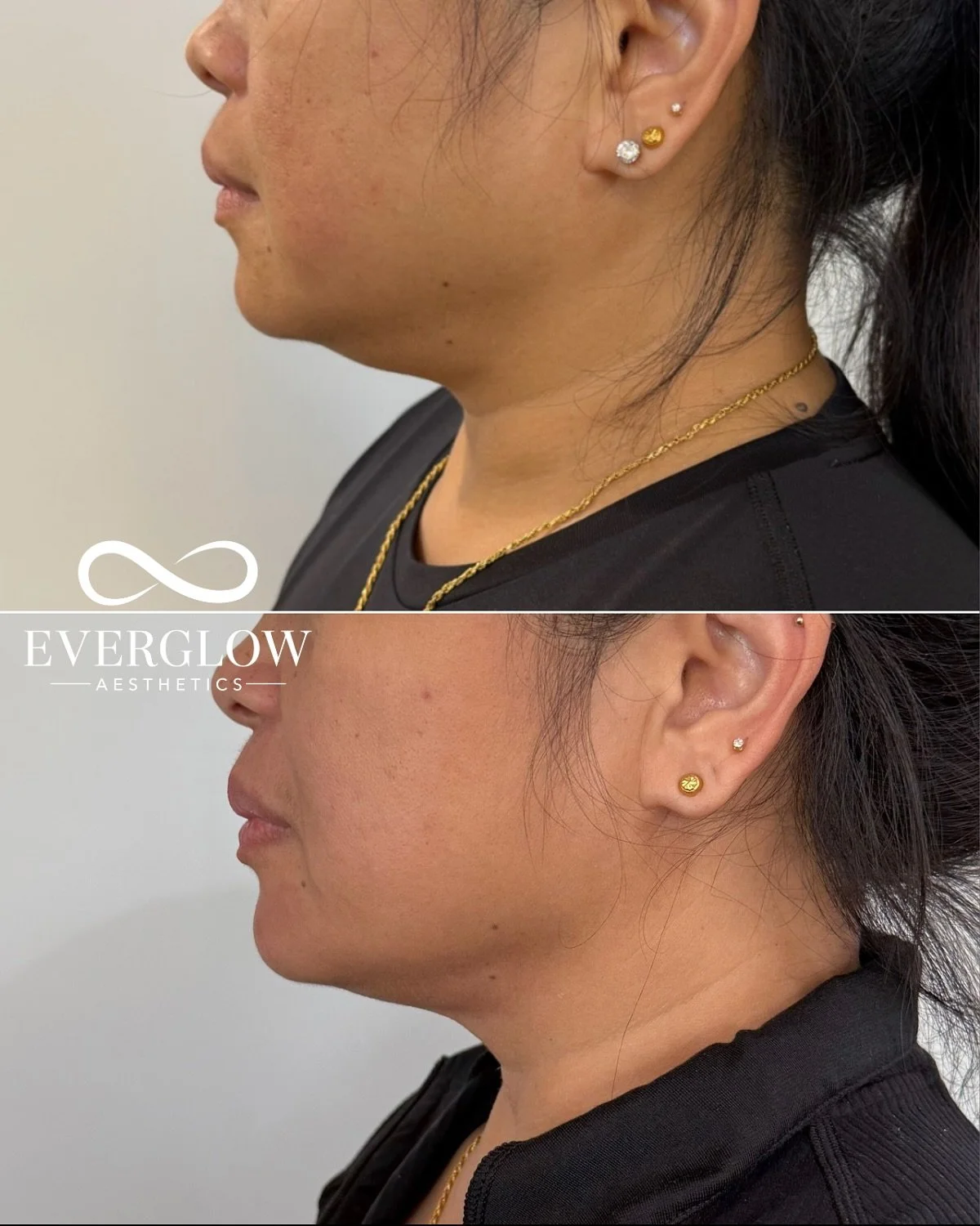 Real results after just one Kybella session 💉
Kybella is the secret to dissolving stubborn fat under the chin. And the best part? The fat cells are gone for good!
Book with @everglowaesthetics ♾️
#kybellatreatment #beforeandafter #facialcontourin