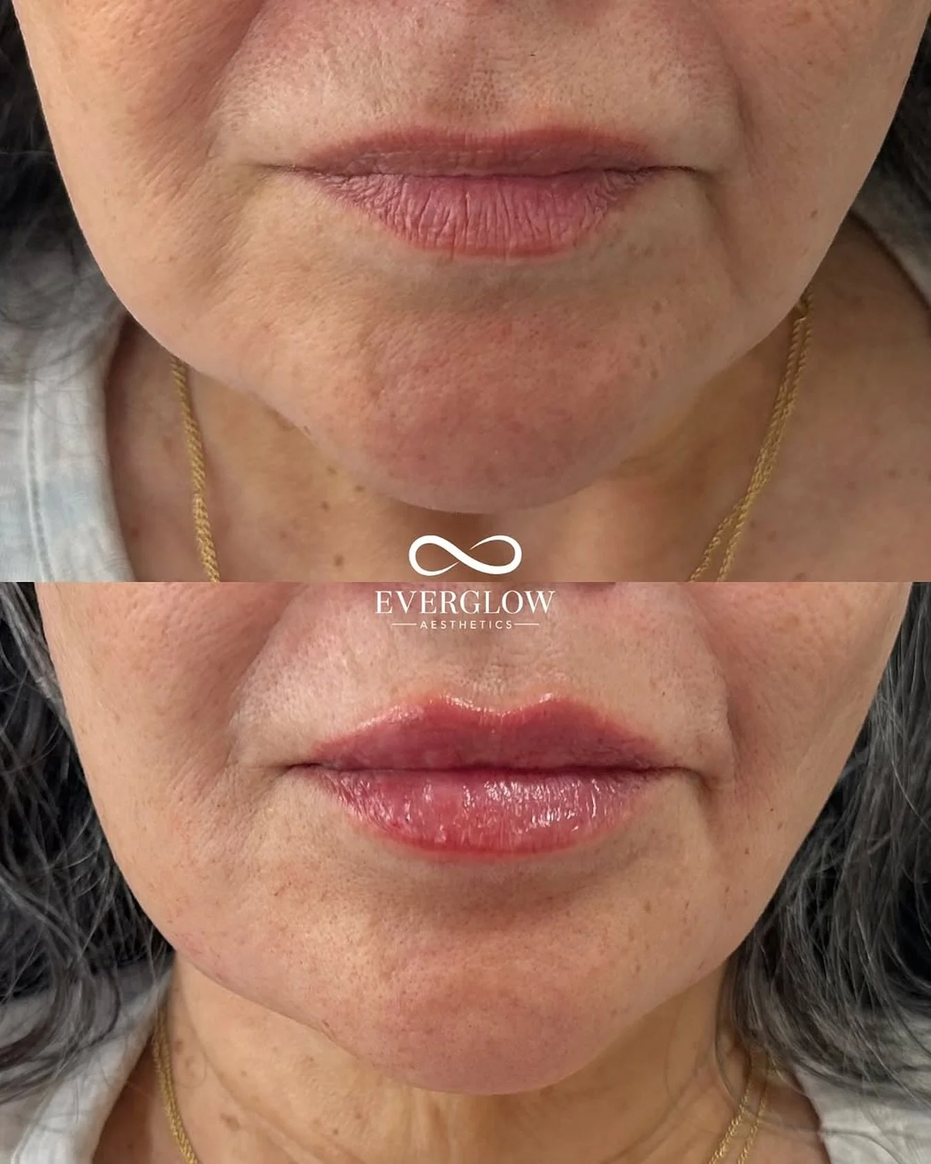 Hydrated, plumped, never overdone 💉

Our approach to lip filler is all about balance: enhancing your natural shape while keeping your lips soft, smooth, and perfectly refreshed!

Book with @everglowaesthetics ♾️