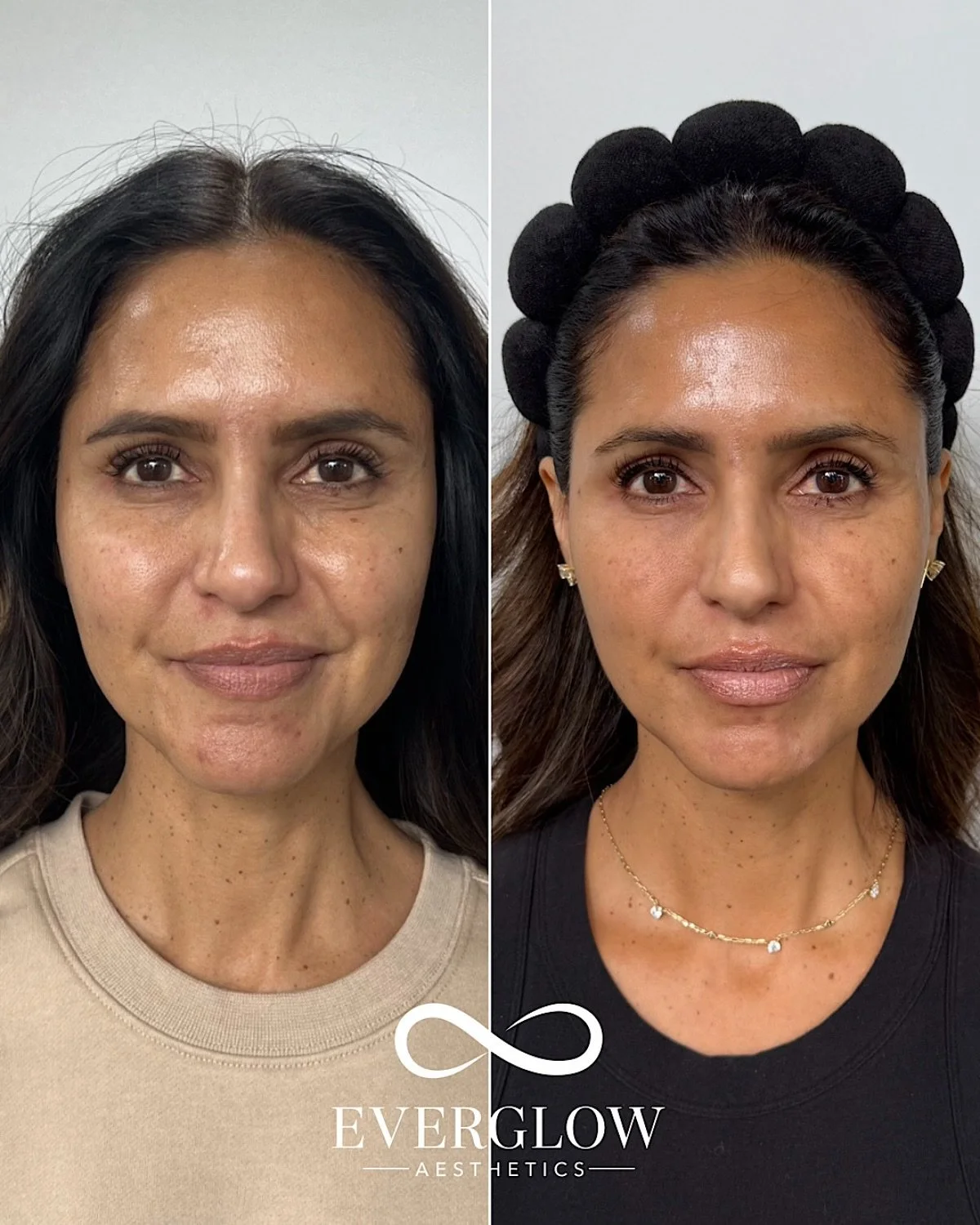 Want a refreshed look without fillers?

Here&rsquo;s how we achieved her results:
✔️ Botox for upper/lower face
✔️ PRFM to treat underage hollowing
✔️ Sylfirm X for skin tightening
+ okay&hellip;and just a tiny bit of lip filler

Book with @everglowa