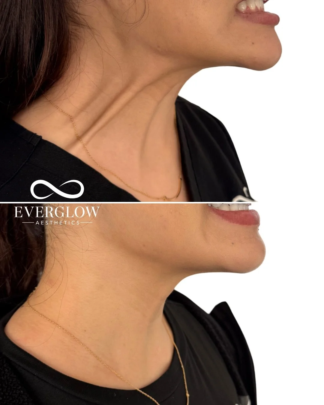 Your neck deserves attention too! 😉

Platysmal bands are the vertical lines that can form on the neck, but with Botox, they can be softened for a smoother, more youthful look.

Treatment by @myaestheticnurse

Individual results may vary. Treated by 