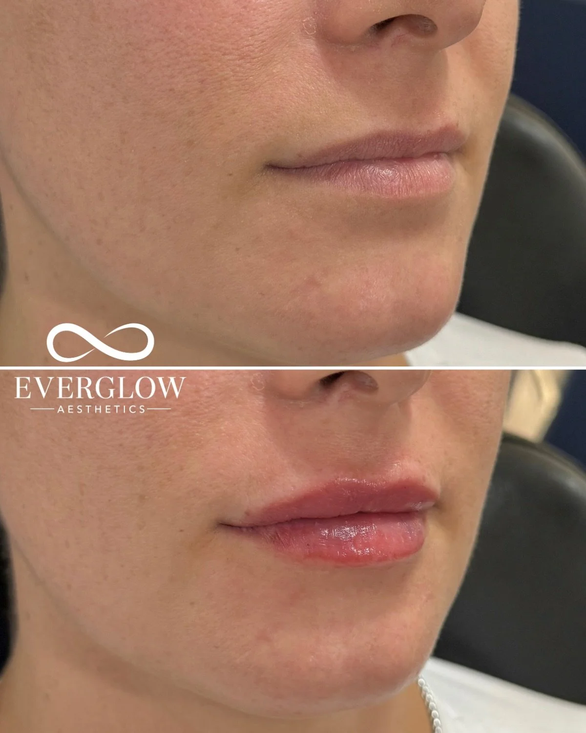&lsquo;Tis the season for hydrated, plush lips 💋✨

Lip filler results that keeps everything looking natural but holiday-ready 🎄

Book your holiday lip filler with @everglowaesthetics ♾️

#naturallips #lipfillerresults #holiday2025