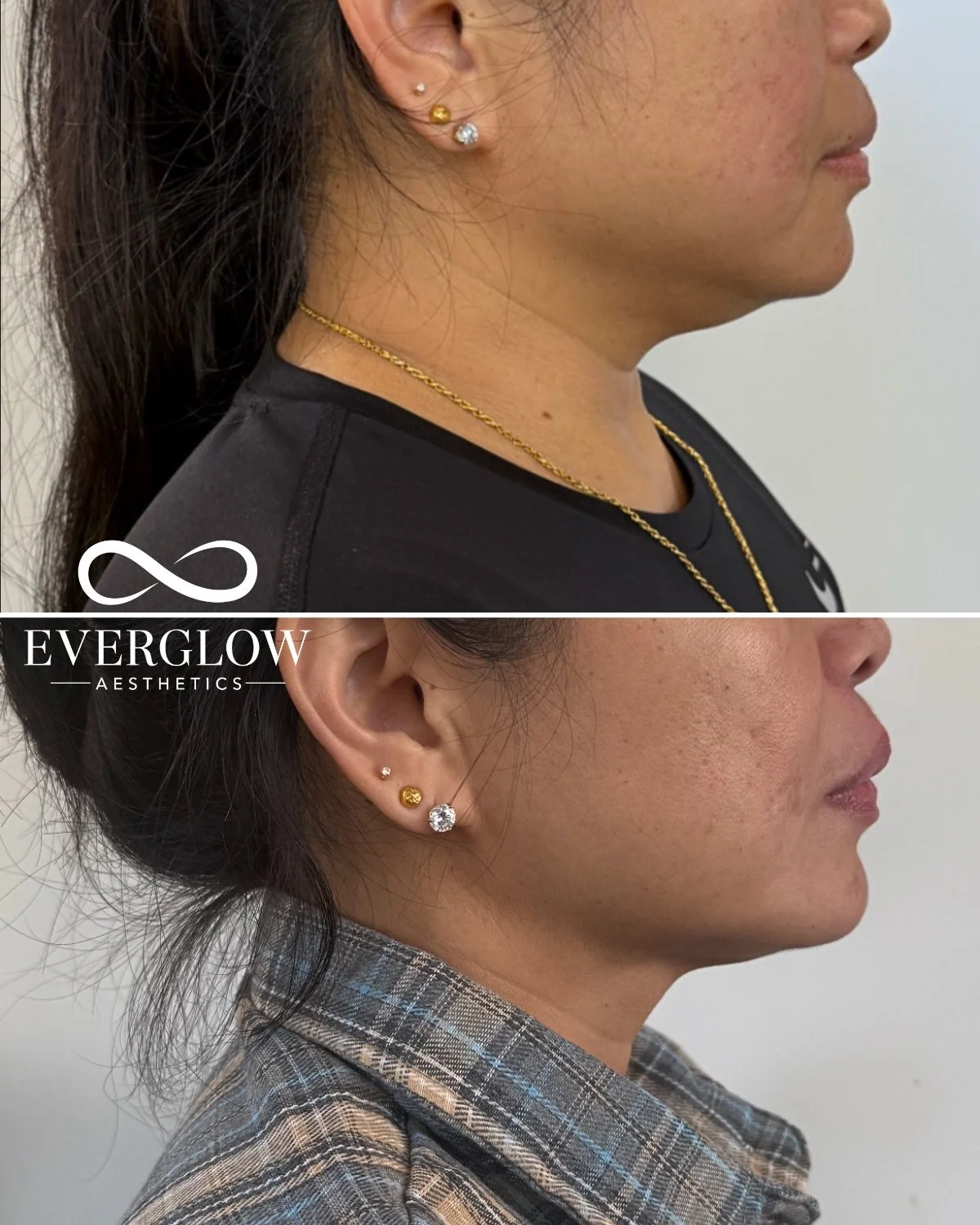 The secret to this sculpted jawline?

A strategic combination of Kybella and platysma Botox!

Kybella works by permanently destroying stubborn fat cells under the chin that don&rsquo;t respond to diet or exercise, helping create a slimmer, more conto