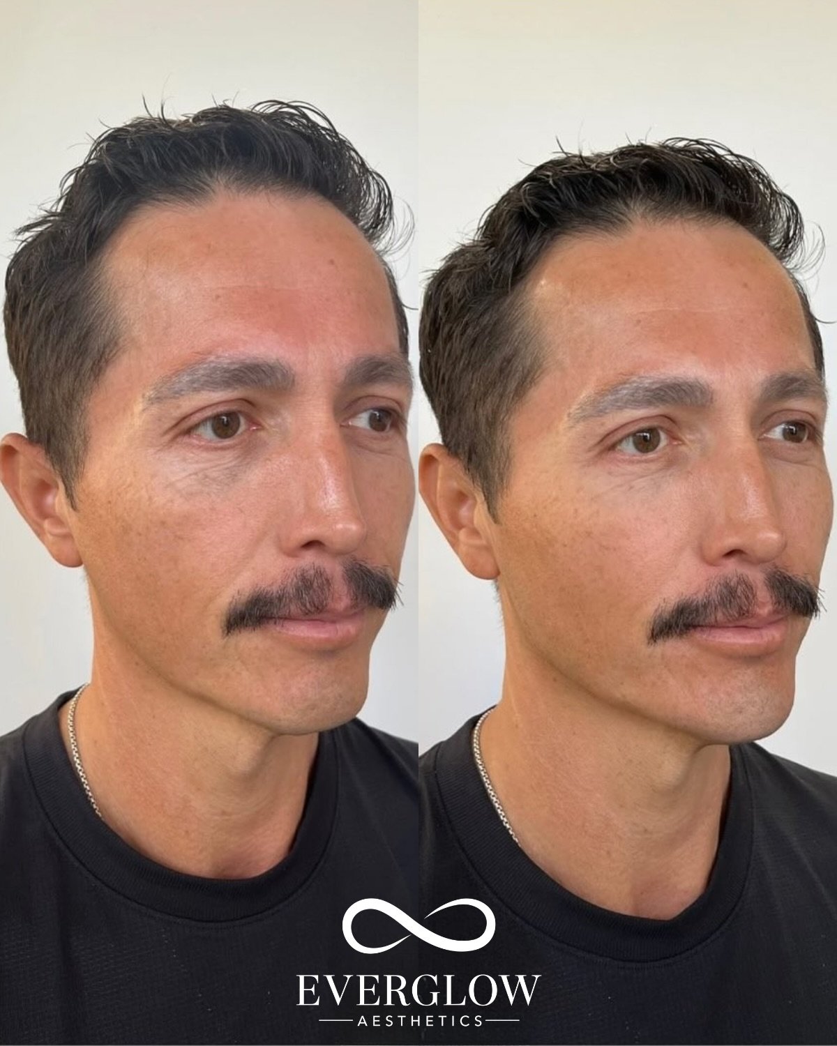 Chin + jaw filler = jawline goals✨

Added definition where it counts with hyaluronic acid filler &mdash; creating a more sculpted, balanced lower face. 

Treatment by @myaestheticnurse 🩶