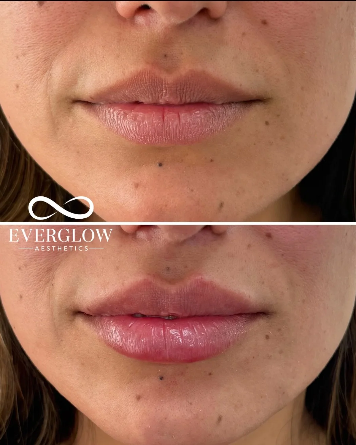 The goal was never bigger lips&hellip;

The goal was hydrated, symmetrical, soft volume that fits her facial structure perfectly 👄💉✨

Book with @everglowaesthetics ♾️

Individual results may vary. Treated by a licensed professional.