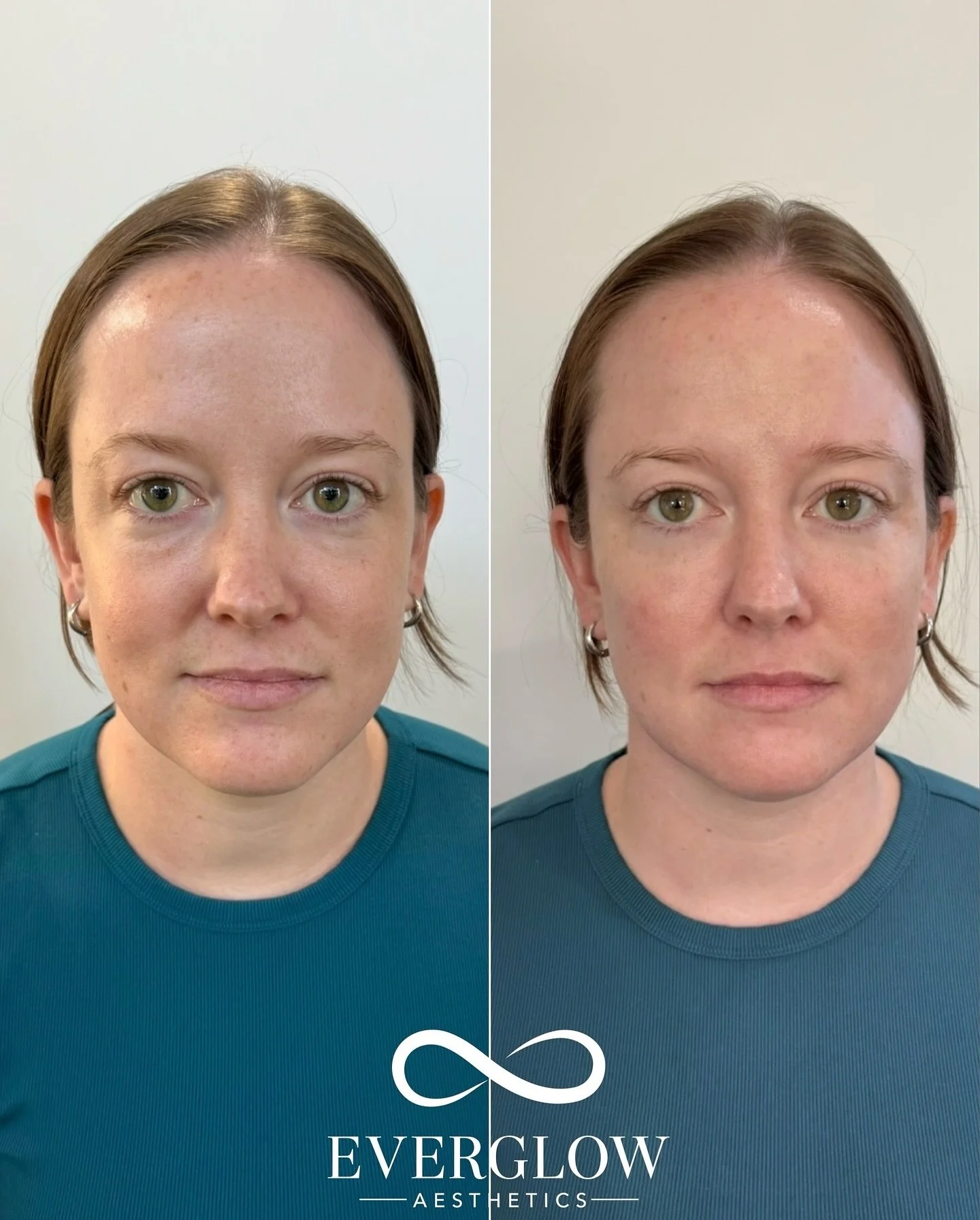 Surgery may be the gold standard for under-eye bags, but it isn&rsquo;t the only option 👀

For this patient, we first added midface support with cheek filler, then addressed the under-eye area to create a smoother, rejuvenated result✨

Mild swelling