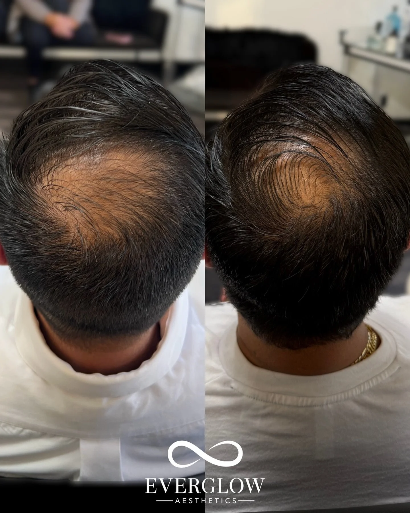 Hair loss, treated at the root &mdash; not masked!

What happens when dual-wave RF energy from Sylfirm X meets regenerative medicine from PRFM. This innovative treatment stimulates dormant hair follicles, encourage new growth, and improves overall sc