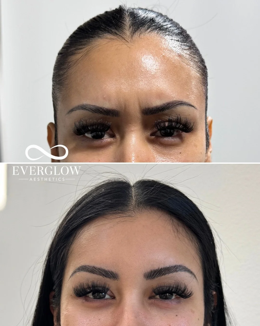 Upper face Botox for a smooth, lifted, &amp; refreshed look✨

Treatment by @myaestheticnurse 🩶

#botoxtreatment #antiagingtreatment #tustinca