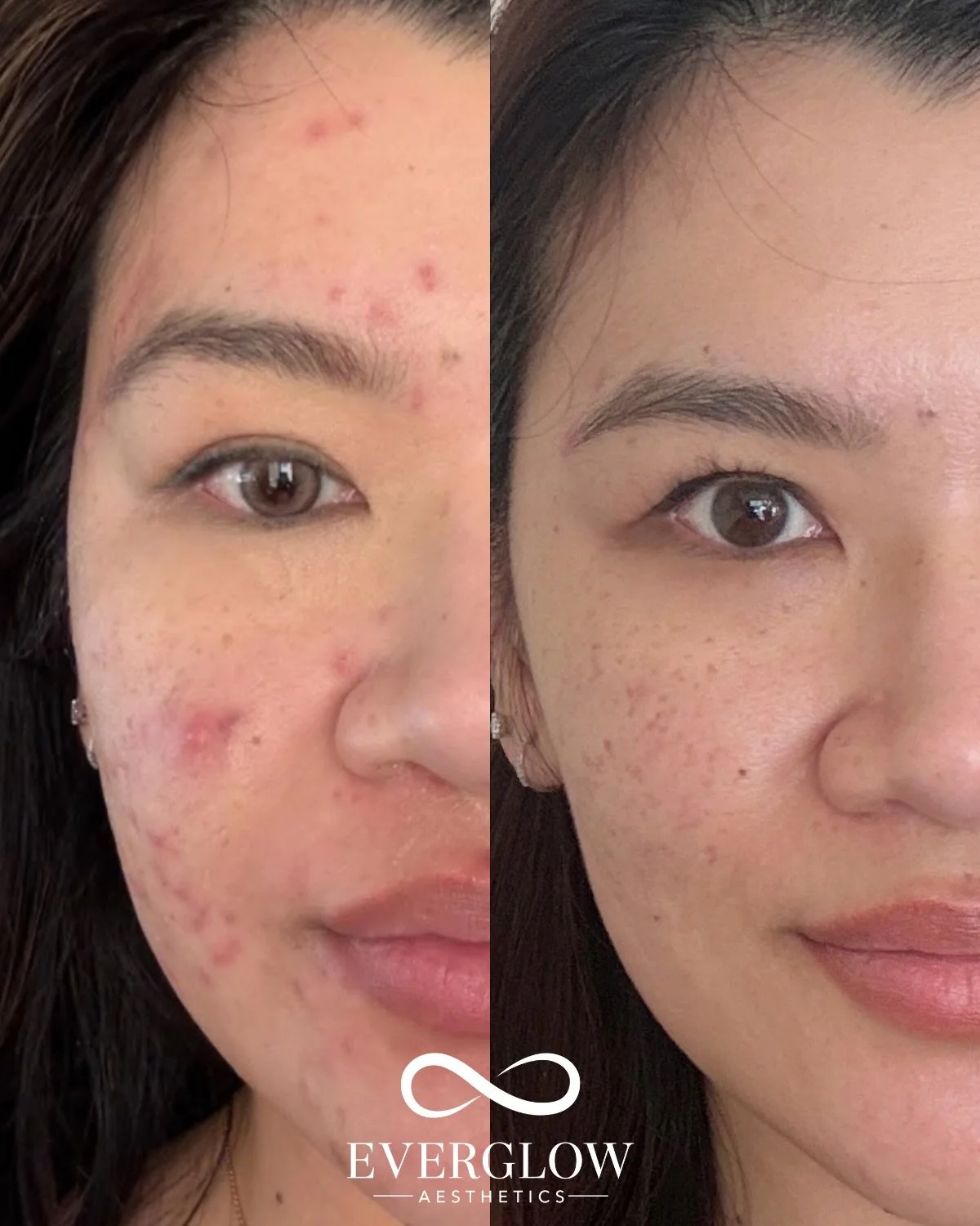 Acne isn&rsquo;t a one-size-fits all, and neither is the treatment!

This transformation was achieved with medical-grade skincare from @skinbetter and @facerealityskincare paired with custom acne facials with @theeocesty to calm inflammation, clear c