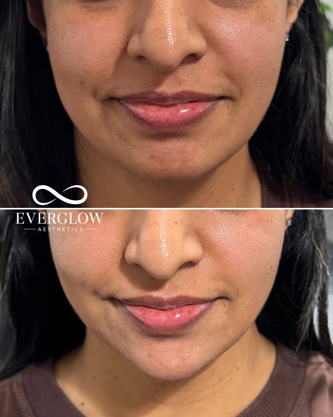 Side profile appreciation post 👏

Chin filler adds structure and elongates the face to complete facial balancing. 

Treatment by @myaestheticnurse 🩶

Book with @everglowaesthetics ♾️

#chinaugmentation #facialbalancing #tustincalifornia