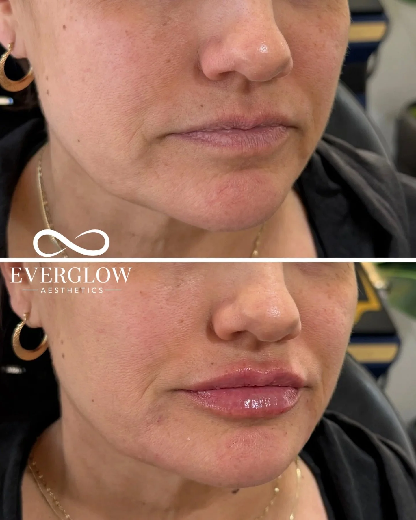 Lips and chin shadow results 💉

It&rsquo;s not always about adding volume, sometimes it&rsquo;s about correcting shadows. With strategic filler placement, we can soften the illusion of heaviness and downturn balance in the lower face &mdash; resulti
