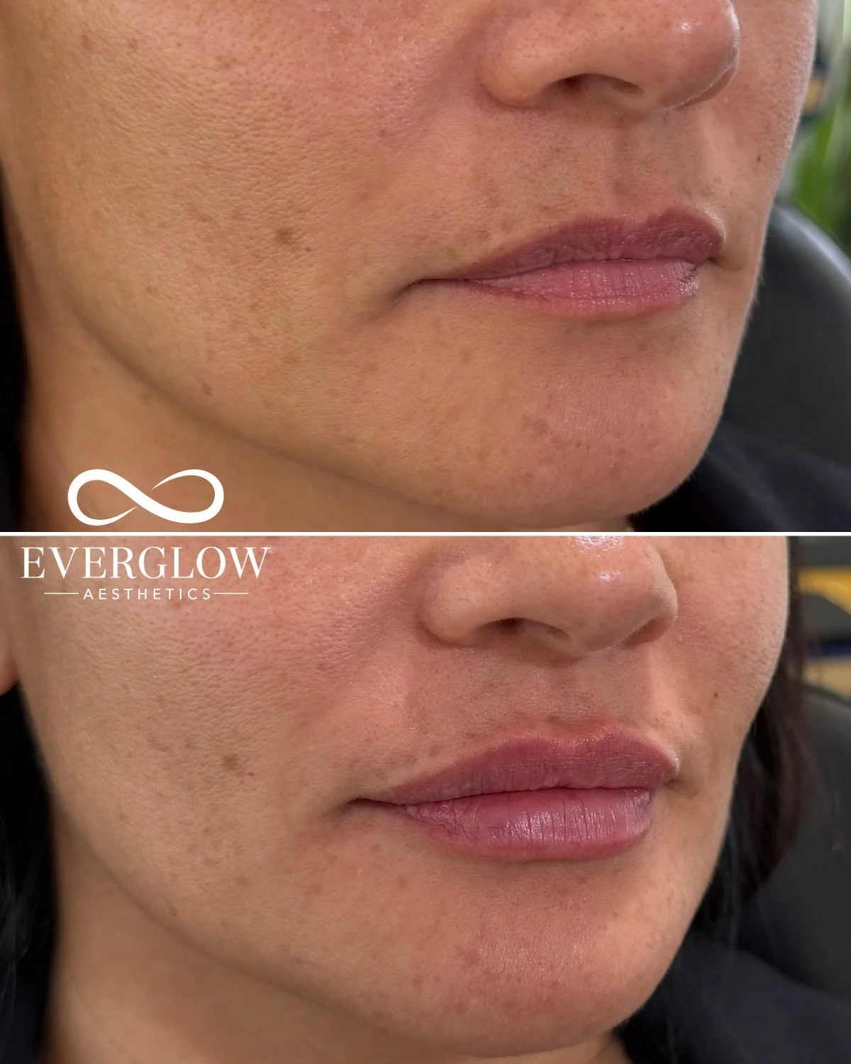 Lip filler isn&rsquo;t about changing your face, it&rsquo;s about enhancing what&rsquo;s already there 🩶

Strategic placement makes all the difference. We enhance the lip structure first, and then volume second. 

If you&rsquo;ve been thinking about