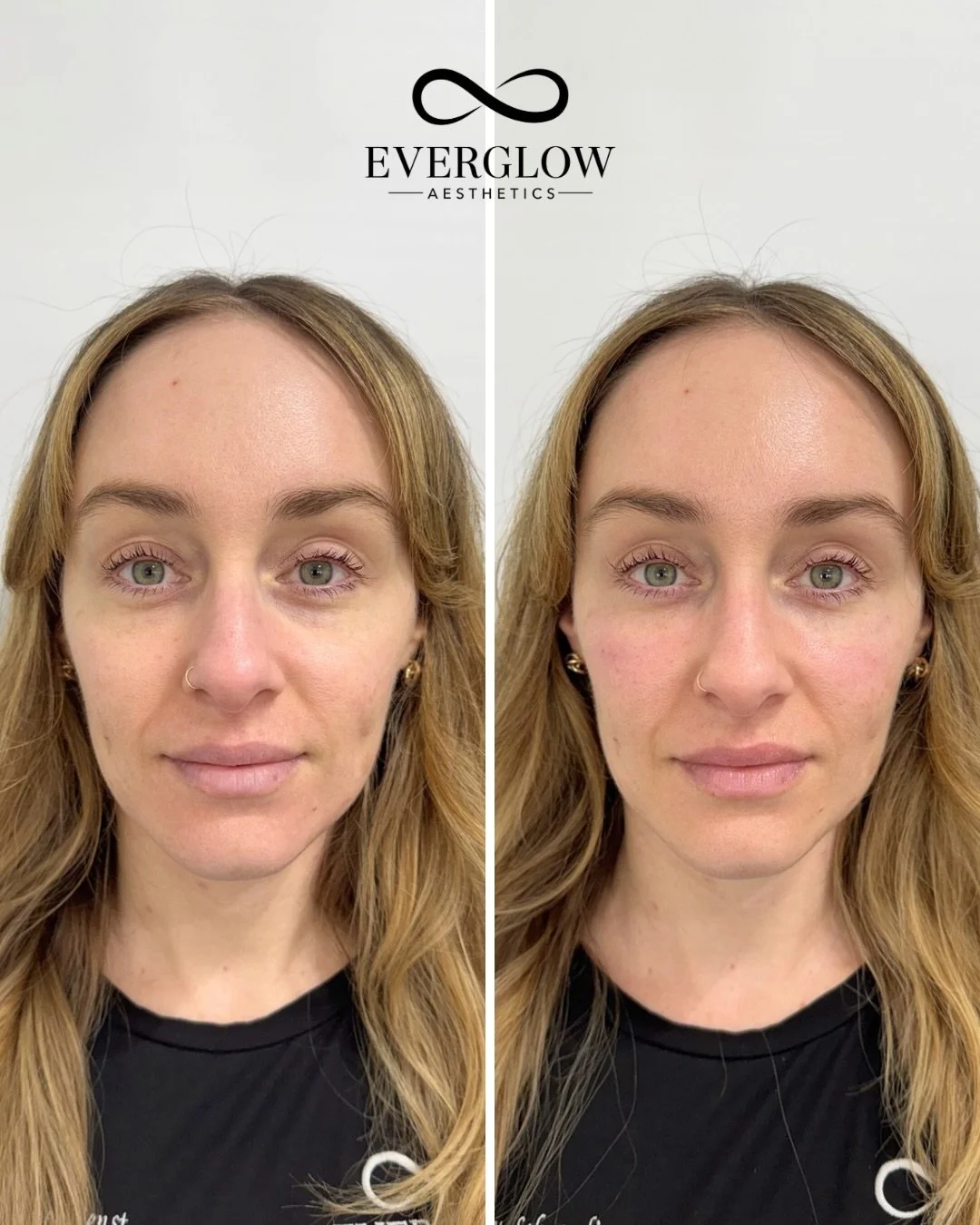 Undereye refresh, customized over time ✔️

This visit: Filler for smooth, seamless support

Previously: PRFM gel to improve skin quality and boost collagen

The best results come with layering treatments, not rushing them!

Treatment by @myaestheticn