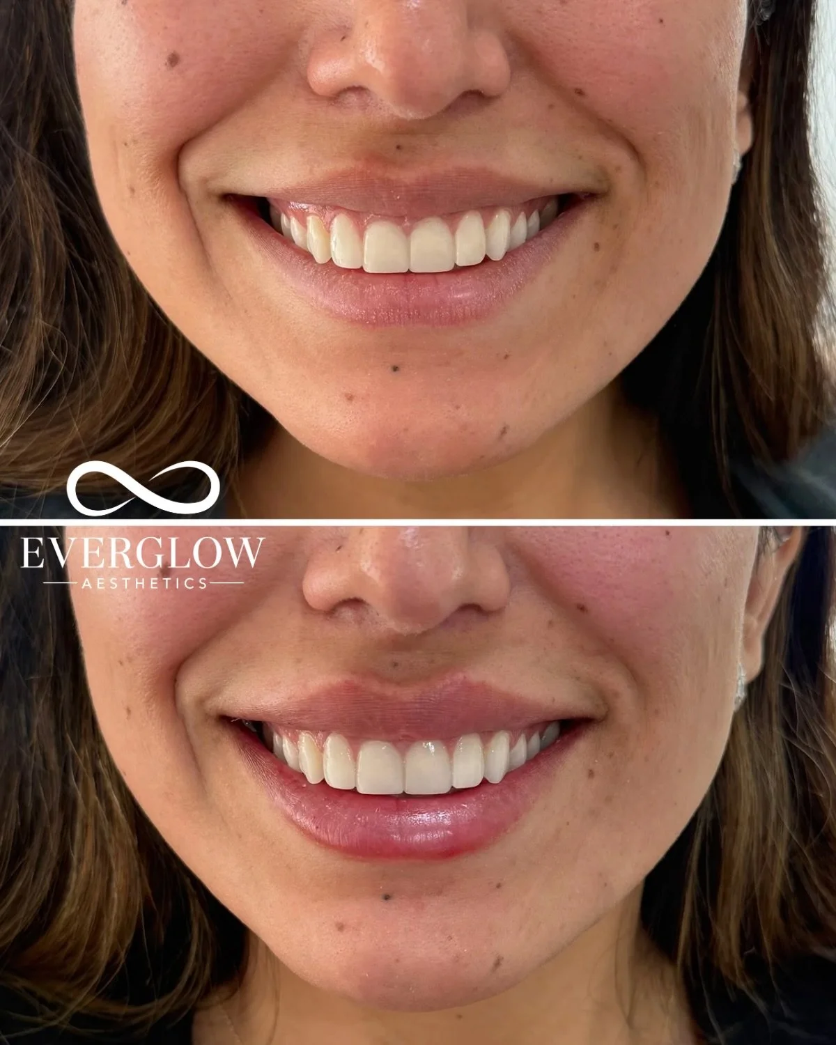 Natural volume that moves with you 👄

Subtle lip enhancement designed to move naturally when you smile! Natural volume with balanced proportions, but with a smile that still feels like you 💉

Individual results may vary. Treated by a licensed profe
