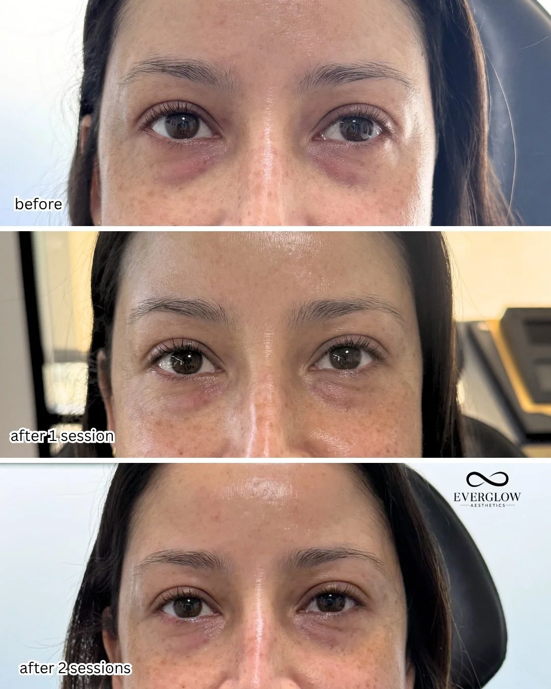 She didn&rsquo;t need undereye filler, she needed this!

3 PRFM sessions to target dark undereyes and improve skin quality&hellip;and now she looks naturally refreshed ✨

This is your reminder that the right treatment > more treatment 💉

Treatmen
