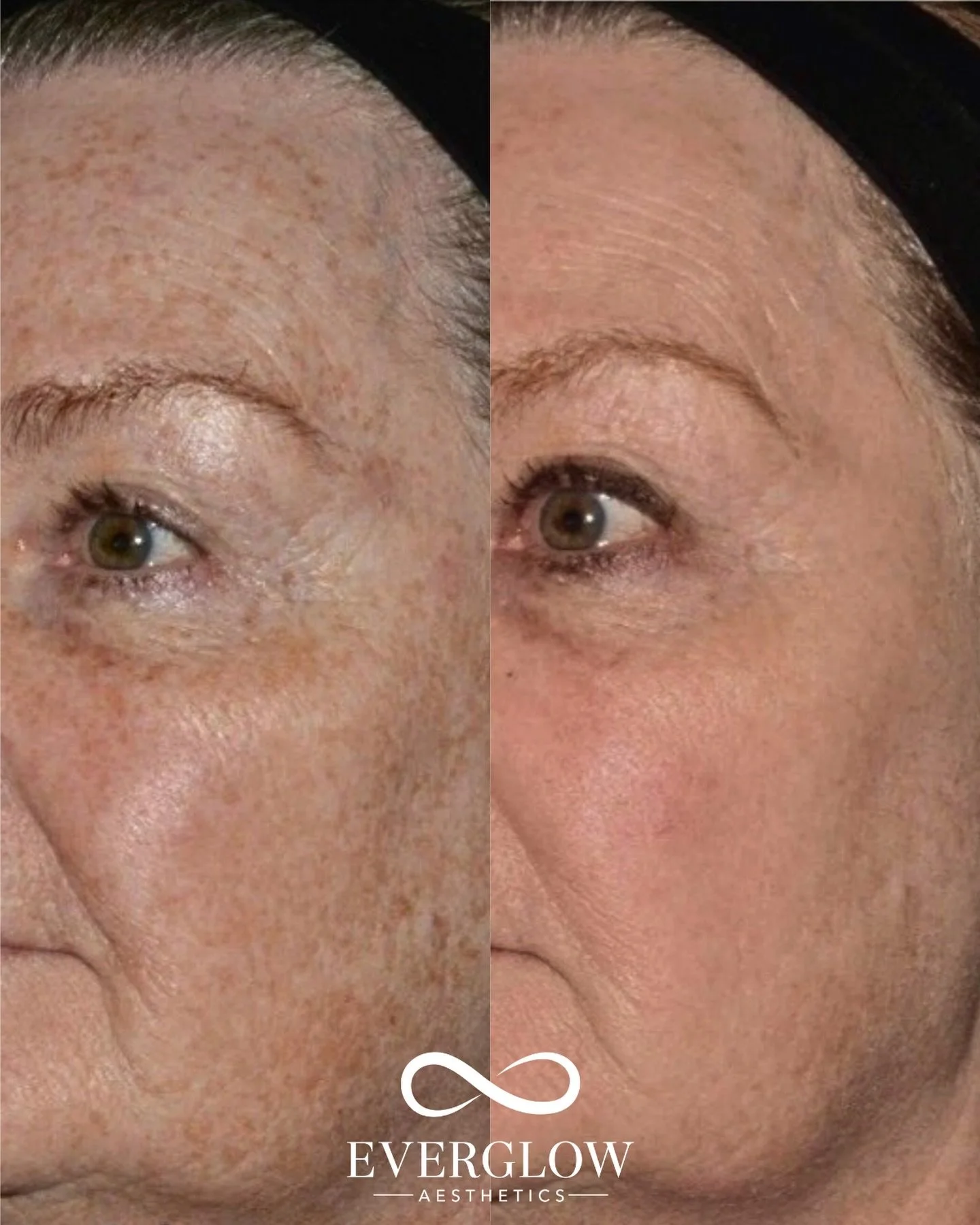 The glow speaks for itself 🤩

After 4 treatments of Ultra Laser&hellip;
✔️ Faded sun damage
✔️ Smoother texture
✔️ Brighter, more even tone

Ultra is a minimal-downtime laser that delivers real results over time! Skin appears more radiant with impro