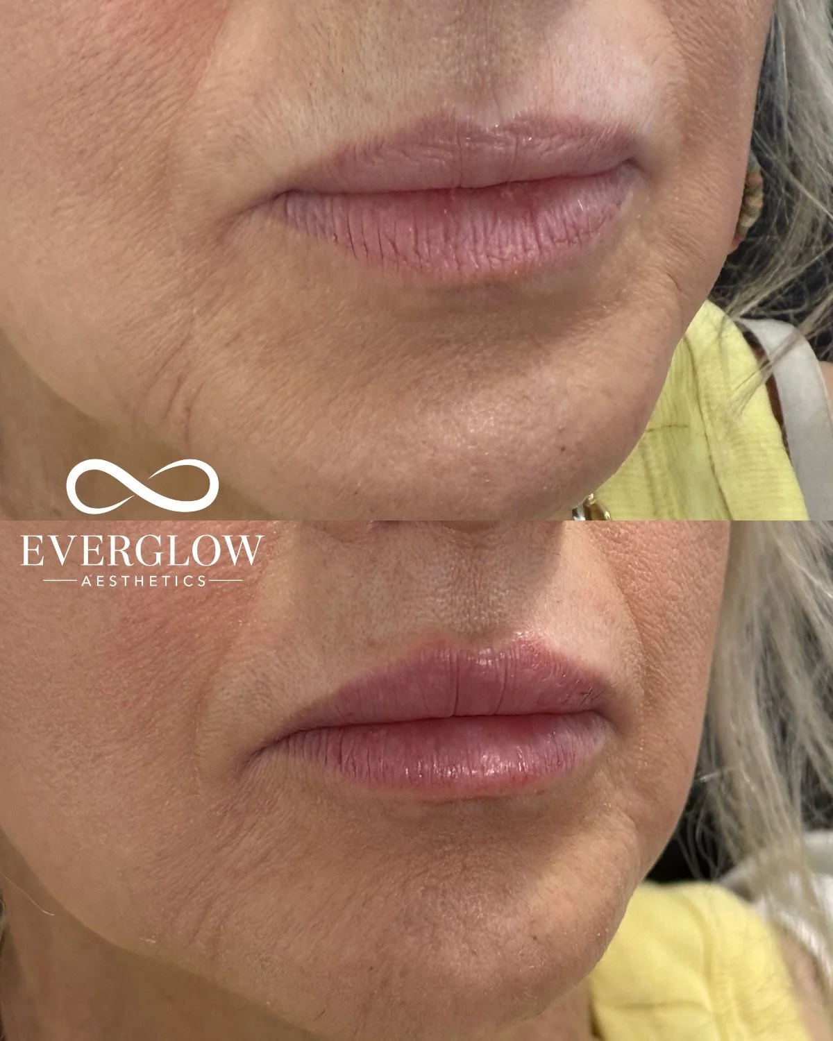 Think refreshed, not obvious 💉

Lip filler isn&rsquo;t just about adding volume, it&rsquo;s also about restoring hydration where your lips need it most! 

Soft, strategic placement helps smooth fine lines, improve texture, and bring back that natura