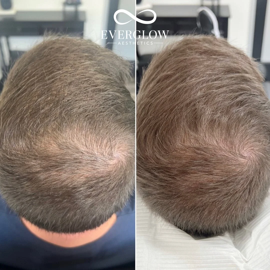 Side-by-side comparison of a person's scalp before and after hair restoration treatment, showing increased hair density and improved appearance.