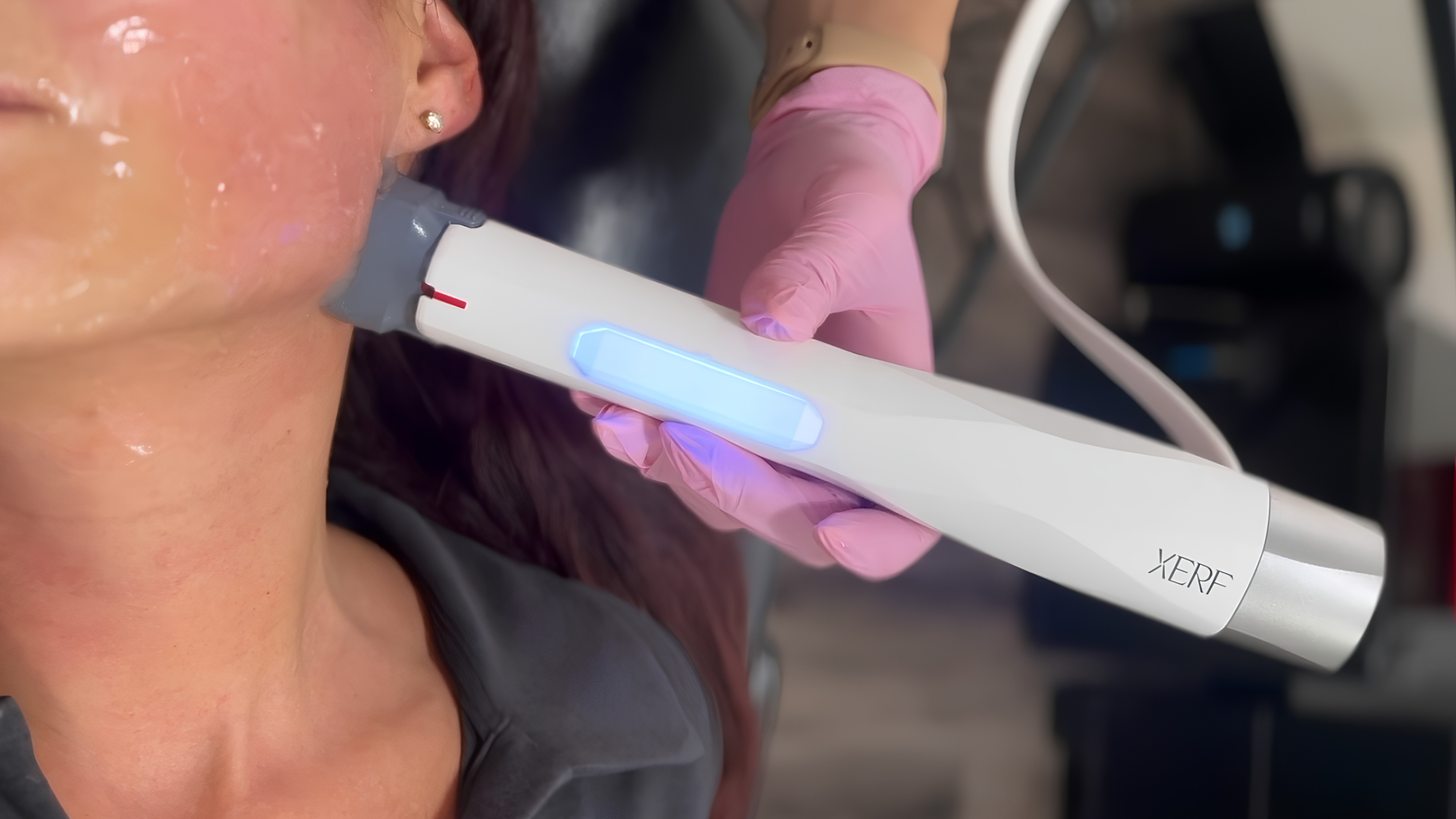 XERF skin tightening treatment along a patient’s jawline at EverGlow Aesthetics in Tustin.