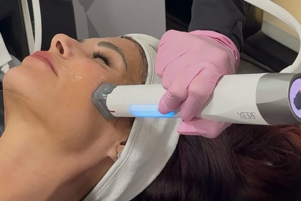 female patient receiving skin tightening collagen stimulation xerf