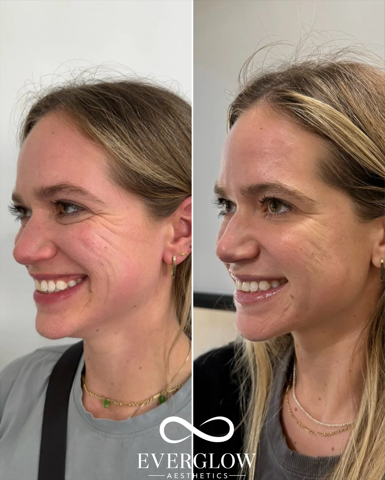 Side-by-side comparison of a woman's face before and after a cosmetic treatment, showing improvements in skin texture and appearance.
