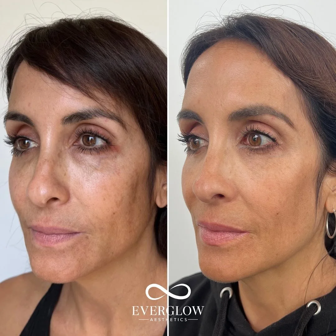 Side-by-side comparison of a woman's face showing before and after a skincare treatment, with visible reduction in dark spots, freckles, and skin discoloration, and improved skin texture.