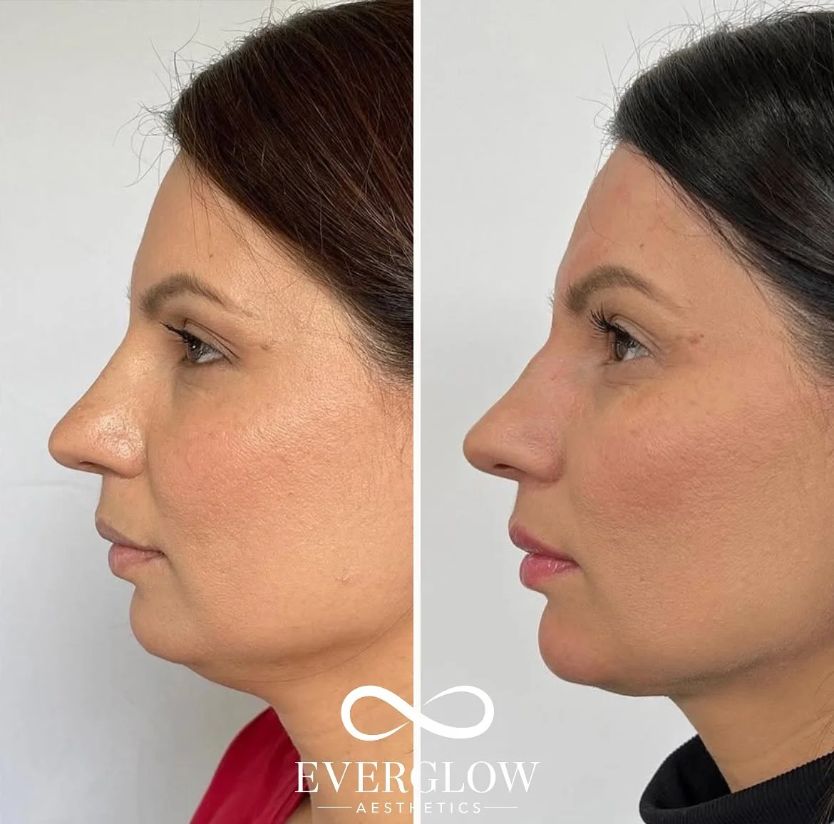 Side-by-side comparison of a woman's face before and after cosmetic treatment showing improved skin texture and contour.