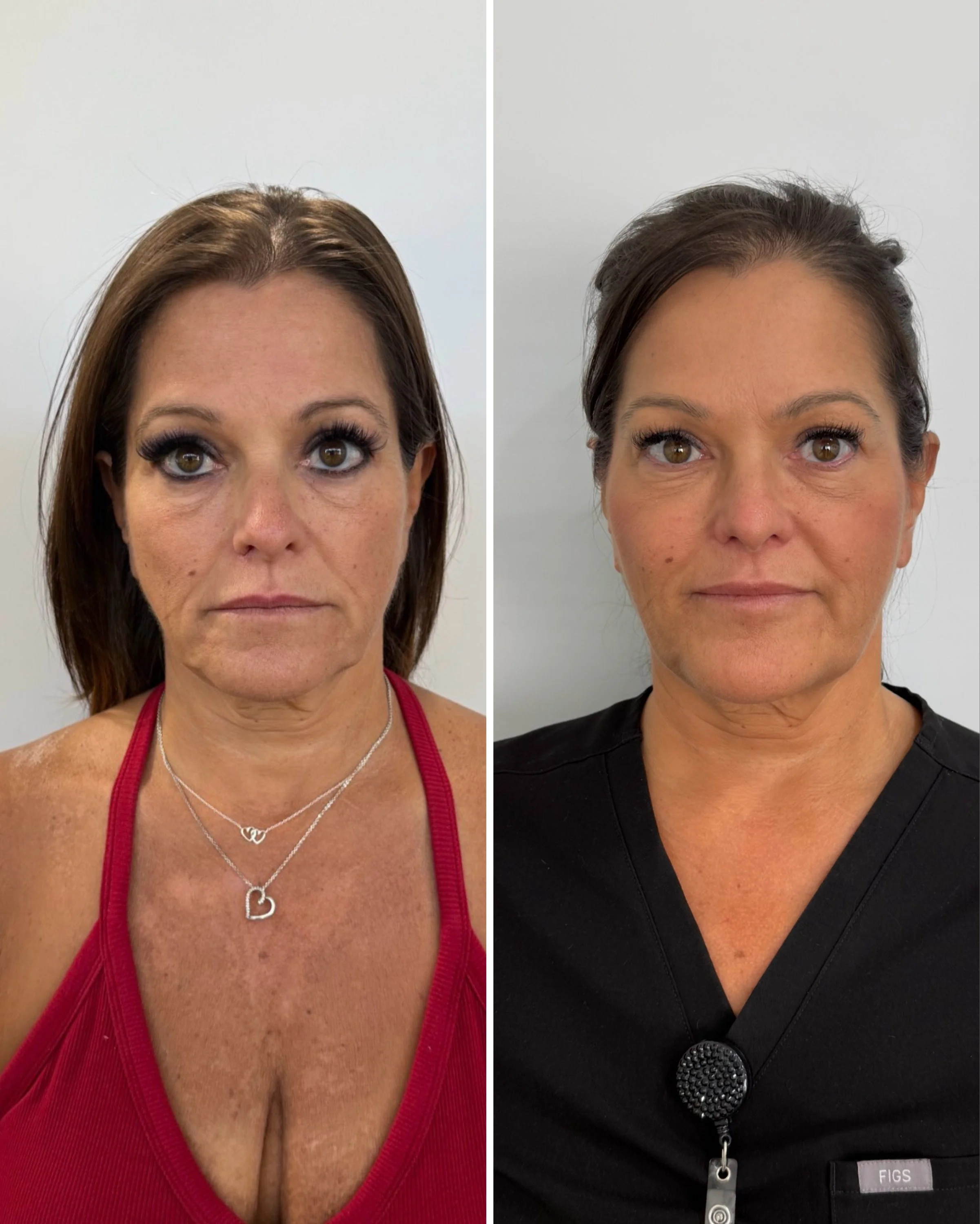 Comparison of two women’s faces before and after cosmetic or skincare treatment, with visible skin improvements.