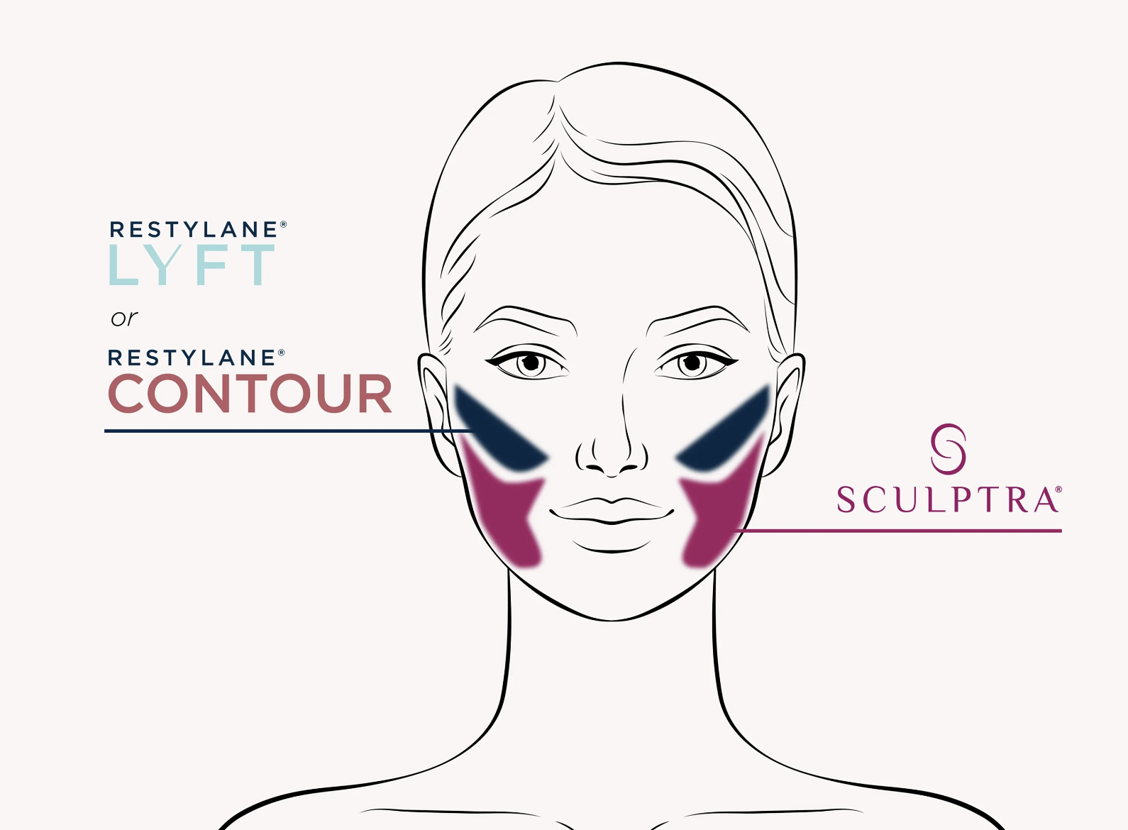 Facial diagram comparing Restylane cheek filler placement with Sculptra treatment areas for facial volume restoration and balancing.