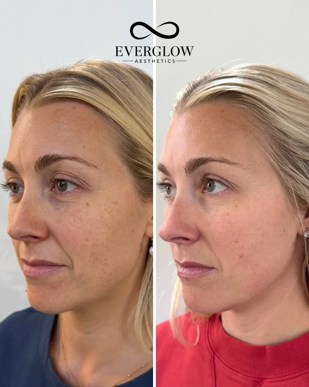 Side-by-side comparison of a woman's face before and after skincare treatment, showing reduced redness and smoother skin.